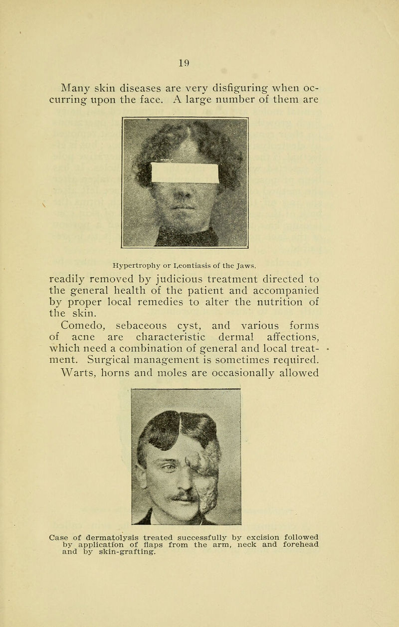 Many skin diseases are very disfiguring- when oc- curring upon tlie face. A large number of them are Hypertrophy or I^eontiasis of the Jaws. readily removed by judicious treatment directed to the general health of the patient and accompanied by proper local remedies to alter the nutrition of the skin. Comedo, sebaceous cyst, and various forms of acne are characteristic dermal affections, which need a combination of general and local treat- ment. Surgical management is sometimes required. Warts, horns and moles are occasionally allowed m %^ Case of dermatolysis treated successfully by excision followed by application of flaps from the arm, neck and forehead and by skin-grafting-.