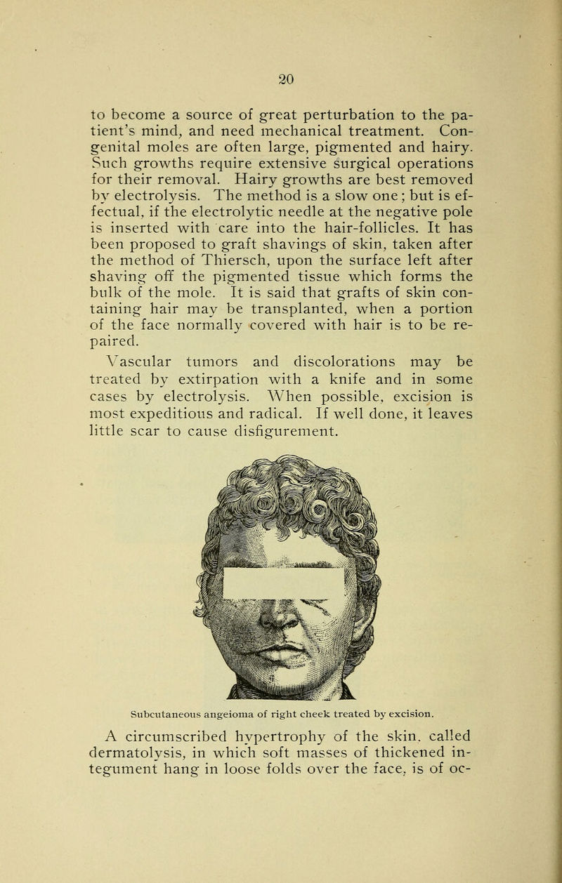 to become a source of great perturbation to the pa- tient's mind^ and need mechanical treatment. Con- genital moles are often large, pigmented and hairy. Such growths require extensive surgical operations for their removal. Hairy growths are best removed by electrolysis. The method is a slow one; but is ef- fectual, if the electrolytic needle at the negative pole is inserted with care into the hair-follicles. It has been proposed to graft shavings of skin, taken after the method of Thiersch, upon the surface left after shaving off the pigmented tissue which forms the bulk of the mole. It is said that grafts of skin con- taining hair may be transplanted, when a portion of the face normally covered with hair is to be re- paired. Vascular tumors and discolorations may be treated by extirpation with a knife and in some cases by electrolysis. When possible, excision is most expeditious and radical. If well done, it leaves little scar to cause disfigurement. Subcutaneous angeioma of right cheek treated by excision. A circumscribed hypertrophy of the skin, called dermatolysis, in which soft masses of thickened in- tegument hang in loose folds over the face, is of oc-