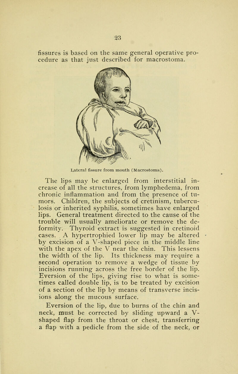 fissures is based on the same general operative pro- cedure as that just described for macrostoma. L,ateral fissure from mouth (Macrostom^a). The Hps may be enlarged from interstitial in- crease of all the structures, from lymphedema, from chronic inflammation and from the presence of tu- mors. Children, the subjects of cretinism, tubercu- losis or inherited syphilis, sometimes have enlarged lips. General treatment directed to the cause of the trouble v^ill usually ameliorate or remove the de- formity. Thyroid extract is suggested in cretinoid cases. A hypertrophied lower lip may be altered by excision of a V-shaped piece in the middle line w^ith the apex of the V near the chin. This lessens the w^idth of the lip. Its thickness may require a second operation to remove a wedge of tissue by incisions running across the free border of the lip. Eversion of the lips, giving rise to what is some- times called double lip, is to be treated by excision of a section of the lip by means of transverse incis- ions along the mucous surface. Eversion of the lip, due to burns of the chin and neck, must be corrected by sliding upward a V- shaped flap from the throat or chest, transferring a flap with a pedicle from the side of the neck, or