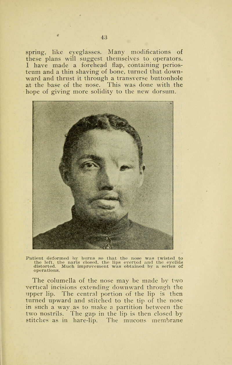 Many spring-, like eyeglasses. Many modifications of these plans Avill suggest themselves to operators. I have made a forehead flap, containing perios- teum and a thin shaving of bone, turned that down- ward and thrust it through a transverse buttonhole at the base of the nose. This was done with the hope of giving more solidity to the new dorsum. Patient deformed by b\irns so that the nose was twisted to the left, the naris closed, the lips everted and the eyelids distorted. Much improvement was obtained by a series of operations. The columella of the nose may be made by two vertical incisions extending downward through the upper lip. The central portion of the lip is then turned upward and stitched to the tip of the nose in such a way as to make a partition between the two nostrils. The gap in the lip is then closed by stitches as in hare-lip. The mucous membrane