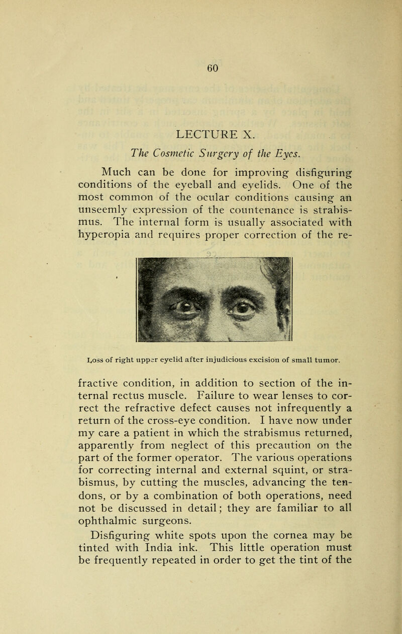 LECTURE X. The Cosmetic Surgery of the Eyes. Much can be done for improving disfiguring conditions of the eyeball and eyelids. One of the most common of the ocular conditions causing an unseemly expression of the countenance is strabis- mus. The internal form is usually associated with hyperopia and requires proper correction of the re- lyoss of right upper eyelid after injudicious excision of small tumor. fractive condition, in addition to section of the in- ternal rectus muscle. Failure to wear lenses to cor- rect the refractive defect causes not infrequently a return of the cross-eye condition. I have now under my care a patient in which the strabismus returned, apparently from neglect of this precaution on the part of the former operator. The various operations for correcting internal and external squint, or stra- bismus, by cutting the muscles, advancing the ten- dons, or by a combination of both operations, need not be discussed in detail; they are familiar to all ophthalmic surgeons. Disfiguring white spots upon the cornea may be tinted with India ink. This little operation must be frequently repeated in order to get the tint of the