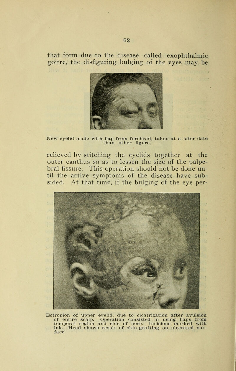 that form due to the disease called exophthalmic goitre, the disfiguring bulging of the eyes may be New eyelid made with flap from forehead, taken at a later date than other figure. relieved by stitching the eyelids together at the outer canthus so as to lessen the size of the palpe- bral fissure. This operation should not be done un- til the active symptoms of the disease have sub- sided. At that time, if the bulging of the eye per- ^ Ectropion of upper eyelid, due to cicatrization after avulsion of entire scalp. Operation consisted in using flaps from temporal region and side of nose. Incisions marked with ink. Head shows result of skin-grafting on ulcerated sur- face.