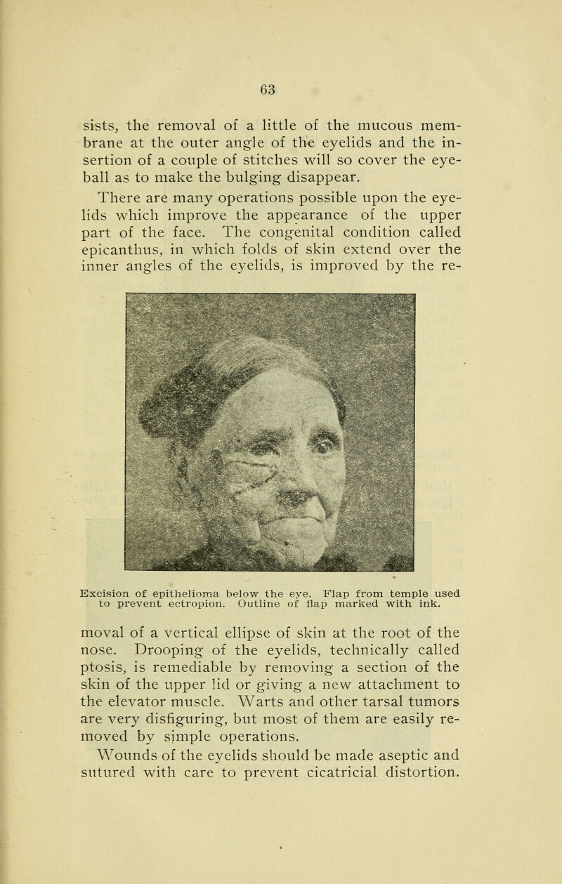 sists, the removal of a little of the mucous mem- brane at the outer angle of the eyelids and the in- sertion of a couple of stitches will so cover the eye- ball as to make the bulging disappear. There are many operations possible upon the eye- lids which improve the appearance of the upper part of the face. The congenital condition called epicanthus, in which folds of skin extend over the inner angles of the eyelids, is improved by the re- .^k.___.^ Excision of epithelioma below the eye. Flap from temple used to prevent ectropion. Outline of flap marked with ink. moval of a vertical ellipse of skin at the root of the nose. Drooping of the eyelids, technically called ptosis, is remediable by rem.oving a section of the skin of the upper lid or giving a new attachment to the elevator muscle. Warts and other tarsal tumors are very disfiguring, but most of them are easily re- moved by simple operations. Wounds of the eyelids should be made aseptic and sutured with care to prevent cicatricial distortion.