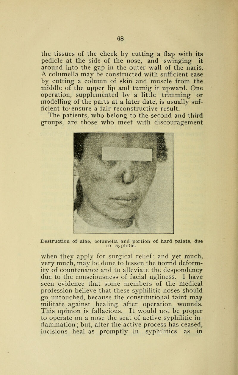 the tissues of the cheek by cutting a flap with its pedicle at the side of the nose, and swinging it around into the gap in the outer wall of the naris. A columella may be constructed with sufficient ease by cutting a column of skin and muscle from the middle of the upper lip and turnig it upward. One operation, supplemented by a little trimming or modelling of the parts at a later date, is usually suf- ficient to' ensure a fair reconstructive result. The patients, who belong to the second and third groups, are those who meet with discouragement Destruction of alae, columella and portion of hard palate, to sj'philis. due when they apply for surgical relief; and yet much, very much, may be done to lessen the norrid deform- ity of countenance and to alleviate the despondency due to the consciousness of facial ugliness. I have seen evidence that some members of the medical profession believe that these syphilitic noses should go untouched, because the constitutional taint may militate against healing after operation wounds. This opinion is fallacious. It would not be proper to operate on a nose the seat of active syphilitic in- flammation ; but, after the active process has ceased, incisions heal as promptly in syphilitics as in