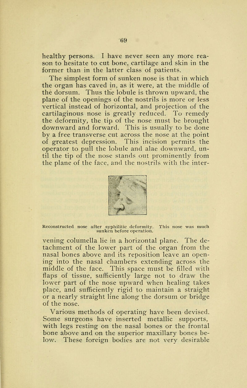 healthy persons. I have never seen any more rea- son to hesitate to cut bone, cartilage and skin in the former than in the latter class of patients. The simplest form of sunken nose is that in which the organ has caved in, as it were, at the middle of the dorsum. Thus the lobule is thrown upward, the plane of the openings of the nostrils is more or less vertical instead of horizontal, and projection of the cartilaginous nose is greatly reduced. To remedy the deformity, the tip of the nose must be brought downward and forward. This is usually to be done by a free transverse cut across the nose at the point of greatest depression. This incision permits the operator to pull the lobule and alae downward, un- til the tip of the nose stands out prominently from the plane of the face, and the nostrils with the inter- fnj Reconstructed nose after syphilitic deformity. This nose was much sunken before operation. vening columella lie in a horizontal plane. The de- tachment of the lower part of the organ from the nasal bones above and its reposition leave an open- ing into the nasal chambers extending across the middle of the face. This space must be filled with flaps of tissue, sufficiently large not to draw the low^er part of the nose upward when healing takes place, and sufficiently rigid to maintain a straight or a nearly straight line along the dorsimi or bridge of the nose. Various methods of operating have been devised. Some surgeons have inserted metallic supports, with legs resting on the nasal bones or the frontal bone above and on the superior maxillary bones be- low. These foreign bodies are not very desirable