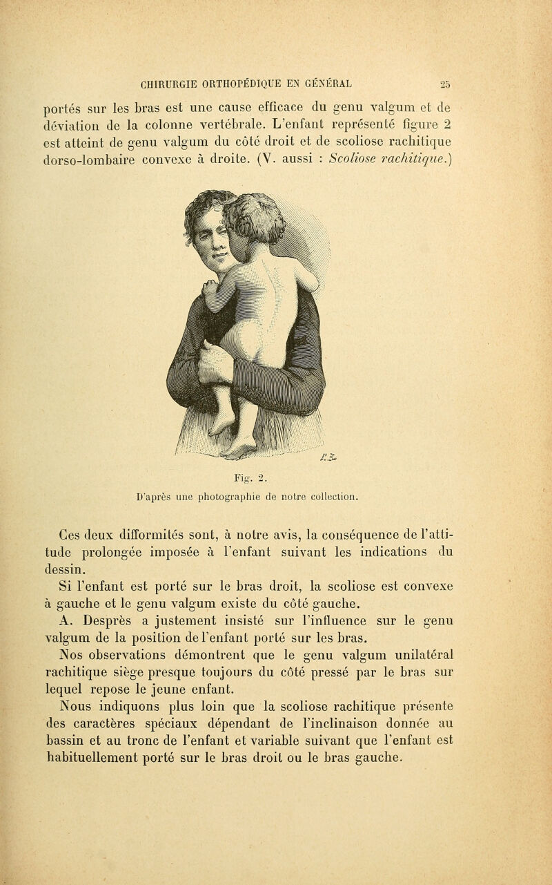 portés sur les bras est une cause efficace du genu valgum et de déviation de la colonne vertébrale. L'enfant représenté figure 2 est atteint de genu valgum du côté droit et de scoliose rachitique dorso-lombaire convexe à droite. (V. aussi : Scoliose rachitique.) €S^ Fig. 2. D'après une photographie de notre collection. Ces deux difformités sont, à notre avis, la conséquence de l'atti- tude prolongée imposée à l'enfant suivant les indications du dessin. Si l'enfant est porté sur le bras droit, la scoliose est convexe à gauche et le genu valgum existe du côté gauche. A. Desprès a justement insisté sur l'influence sur le genu valgum de la position de l'enfant porté sur les bras. Nos observations démontrent que le genu valgum unilatéral rachitique siège presque toujours du côté pressé par le bras sur lequel repose le jeune enfant. Nous indiquons plus loin que la scoliose rachitique présente des caractères spéciaux dépendant de l'inclinaison donnée au bassin et au tronc de l'enfant et variable suivant que l'enfant est habituellement porté sur le bras droit ou le bras gauche.