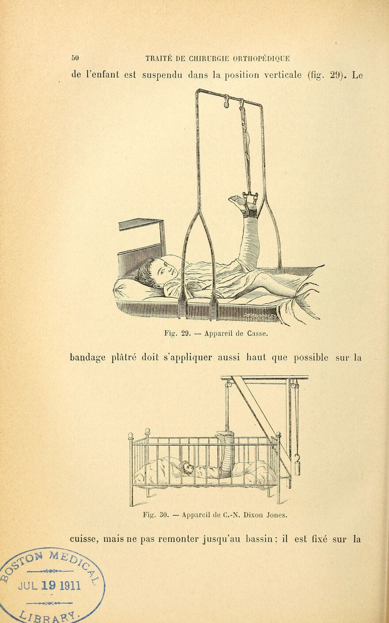 de l'enfant est suspendu dans la position verticale (fîg. 29). Le Fig. 29. — Appareil de Casse. bandage plâtré doit s'appliquer aussi haut que possible sur la Fig. 30. — Appareil de C.-N, Dixon Jones. cuisse, mais ne pas remonter jusqu'au bassin; il est fixé sur la ^ JUL19 1911 ^ ^V^/B R A?~l