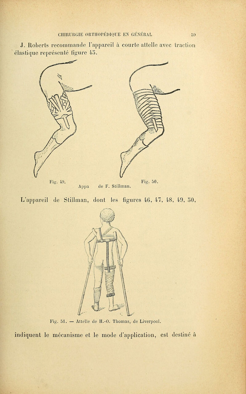 J. Roberts recommande Tappareil à courte attelle avec traction élastique représenté figure 4o. Fig. 49. Fig. 50. Appa de F. Stillman. L'appareil de Stillman, dont les figures 46, 47, 48, 49, 50, i Fig. 51. — Attelle de H.-O. Thomas, de Liverpoo). indiquent le mécanisme et le mode d'application, est destiné à