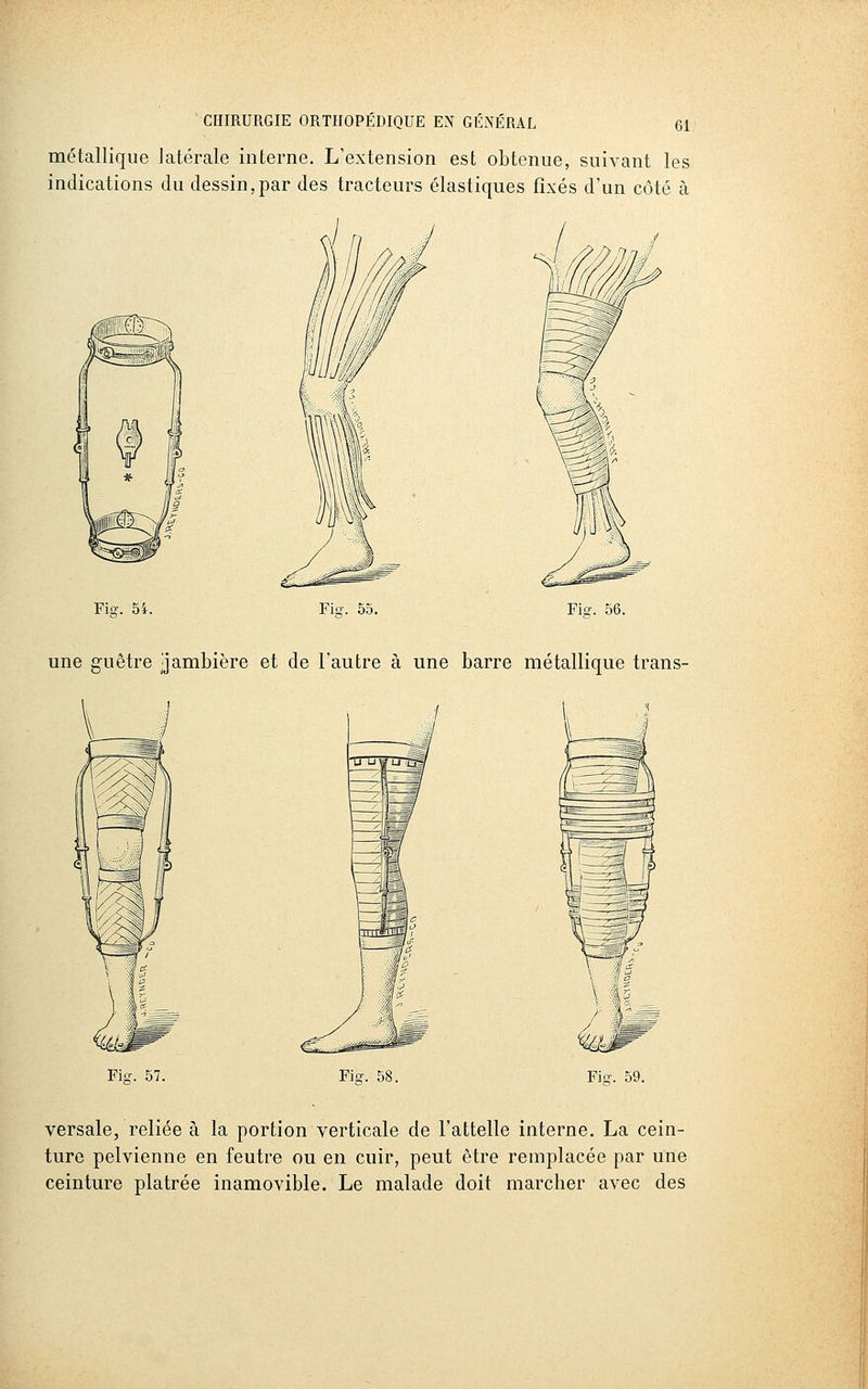 métallique latérale interne. L'extension est obtenue, suivant les indications du dessin,par des tracteurs élastiques fixés d'un côté à Fi!?. 54. Fio-. 56. une guêtre jambière et de l'autre à une barre métallique trans- Fiff. 57. Fig. 58. Fi'. 59. versale, reliée à la portion verticale de l'attelle interne. La cein- ture pelvienne en feutre ou en cuir, peut être remplacée par une ceinture plâtrée inamovible. Le malade doit marcher avec des