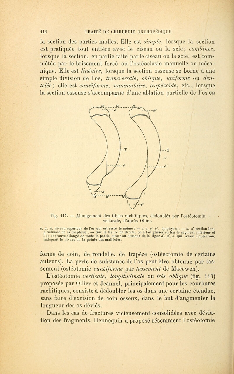 la section des parties molles. Elle est simple, lorsque la section est pratiquée tout entière avec le ciseau ou la scie; combinée, lorsque la section, en partie faite parle ciseau ou la scie, est com- plétée par le brisement forcé ou l'ostéoclasie manuelle ou méca- nique. Elle est linéah^e, lorsque la section osseuse se borne à une simple division de Fos, transversale, oblique, uniforme ou den- telée; elle est cunéiforme, nummulaire, trapézoïde, etc., lorsque la section osseuse s'accompagne d'une ablation partielle de l'os en -4—1 Fig. 117. — Allongement des tibias rachitiques, dédoublés par l'ostéotomie verticale, d'après OUier. «, a, a, niveau supérieur de l'os qui est resté le même ; — e, e, e', e', épiphyses ; — 0,0' section lon- gitudinale de la diaphyse ; — Sur la figure de droite, on a fait glisser en bas le segment inférieui* et l'os se trou-ve allongé de toute la partie située au-dessous de la ligne a\ a', a' qui, avant l'opération, indiquait le niveau de la pointe des malléoles. forme de coin, de rondelle, de trapèze (ostéectomie de certains auteurs). La perte de substance de l'os peut être obtenue par tas- sement (ostéotomie cunéifor^ne par tassement de Macewen). L'ostéotomie verticale, longitudinale ou très oblique (fig. 117) proposée par Ollier et Jeannel, principalement pour les courbures rachitiques, consiste à dédoubler les os dans une certaine étendue, sans faire d'excision de coin osseux, dans le but d'augmenter la longueur des os déviés. Dans les cas de fractures vicieusement consolidées avec dévia- tion des fragments, Ilennequin a proposé récemment l'ostéotomie