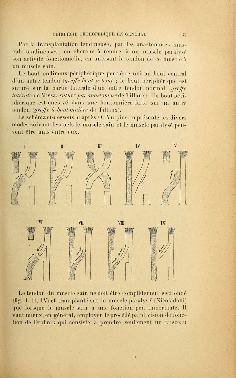 Par la transplantalion tendineuse, par les anastomoses miis- culo-tendineiiscs , on cherche à rendre à un muscle paralysé son activité fonctionnelle, en unissant le tendon de ce muscle à un muscle sain. Le hout tendineux périphérique peut être uni au bout central d'un autre tendon [greffe bout à bout)] le bout périphérique est suturé sur la partie latérale d'un autre tendon normal [greffe latérale de Missa, sature par anasto?nose de Tillaux). Un bout péri- phérique est enclavé dans une boutonnière faite sur un autre tendon [greffe à boutonnière de Tillaux). Le schéma ci-dessous, d'après 0. VuJpius, représente les divers modes suivant lesquels le muscle sain et le muscle paralysé peu- vent être unis entre eux. WL J Le tendon du muscle sain ne doit être complètement sectionné (fig. I, II, IV) et transplanté sur le muscle paralysé' (Nicoladoni) que lorsque le muscle sain a une fonction peu importante. Il vaut mieux, en général, employer le procédé par division de fonc- tion de Drobnik qui consiste à prendre seulement un faisceau
