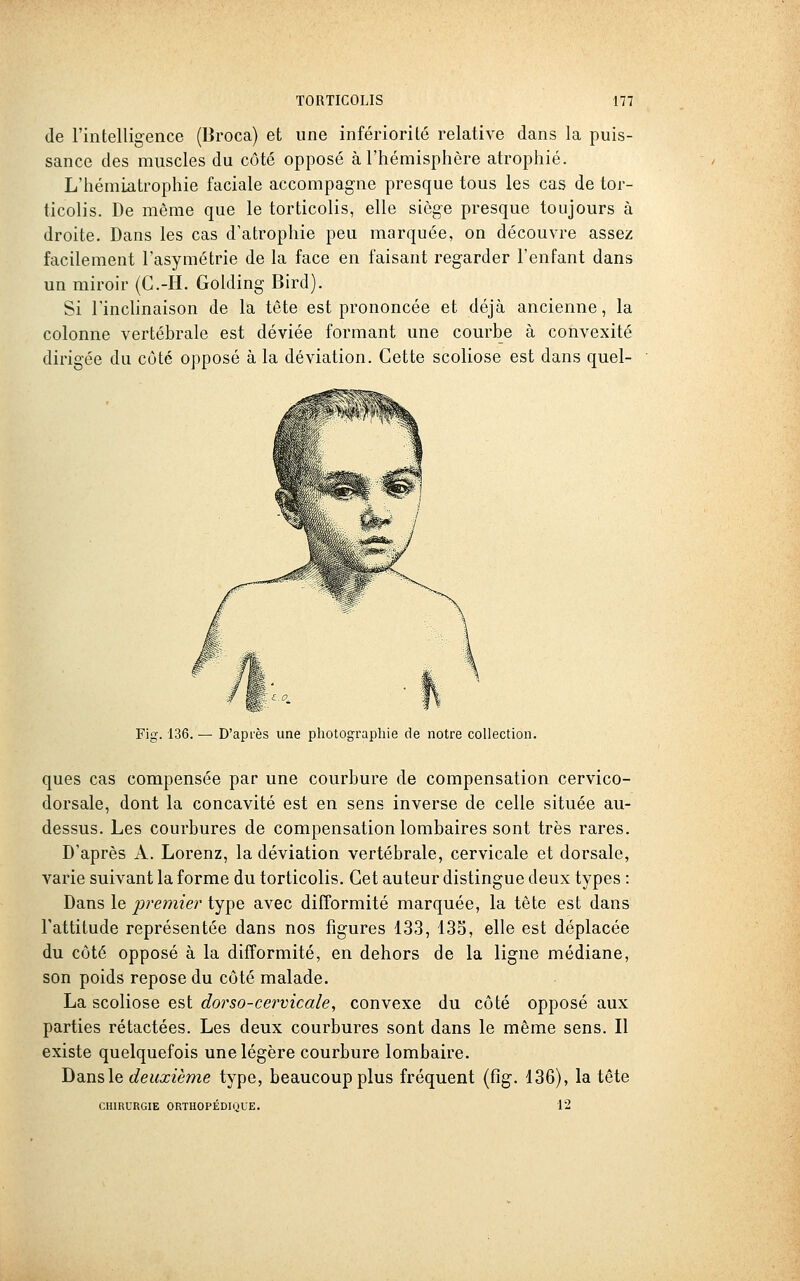 de l'intelligence (Broca) et une infériorité relative dans la puis- sance des muscles du côté opposé à l'hémisphère atrophié. L'hémiatrophie faciale accompagne presque tous les cas de tor- ticolis. De même que le torticolis, elle siège presque toujours à droite. Dans les cas d'atrophie peu marquée, on découvre assez facilement l'asymétrie de la face en faisant regarder l'enfant dans un miroir (G.-H. Golding Bird). Si l'inchnaison de la tête est prononcée et déjà ancienne, la colonne vertébrale est déviée formant une courbe à convexité dirigée du côté opposé à la déviation. Cette scoliose est dans quel- Fig. 136. — D'après une photographie de notre collection. ques cas compensée par une courbure de compensation cervico- dorsale, dont la concavité est en sens inverse de celle située au- dessus. Les courbures de compensation lombaires sont très rares. D'après A. Lorenz, la déviation vertébrale, cervicale et dorsale, varie suivant la forme du torticolis. Cet auteur distingue deux types : Dans le joremier type avec difformité marquée, la tête est dans l'attitude représentée dans nos figures 133, 135, elle est déplacée du côté opposé à la difformité, en dehors de la ligne médiane, son poids repose du côté malade. La scoliose est dorso-cervicale, convexe du côté opposé aux parties rétactées. Les deux courbures sont dans le même sens. Il existe quelquefois une légère courbure lombaire. Dans le tife«même type, beaucoup plus fréquent (fîg. 136), la tête CHIRURGIE ORTHOPÉDIQUE. 12