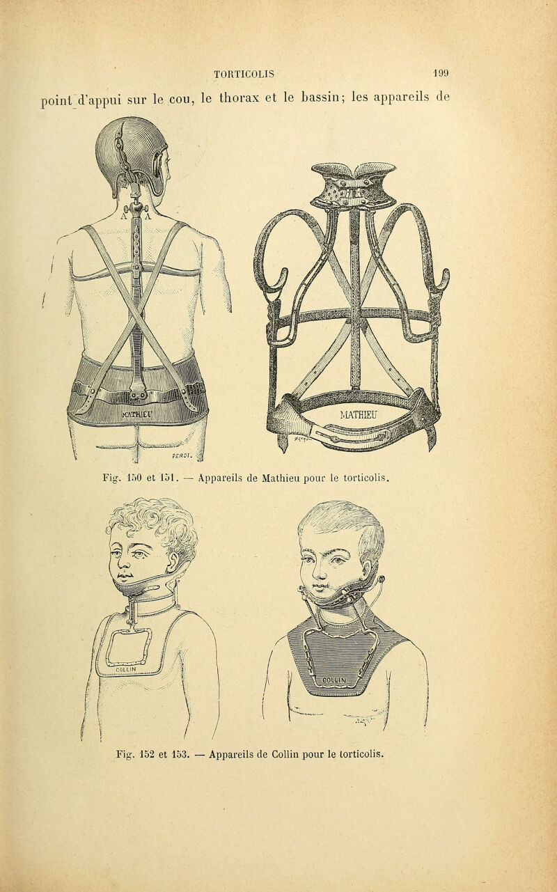 poini'd'appui sur le cou, le thorax et le bassin; les appareils de Fig. 152 et 153. — Appareils de CoUin pour le torticolis.