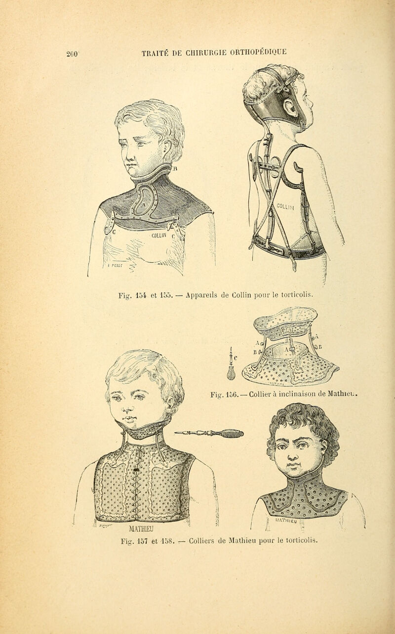 !^;;^;rrf~^--^^ Fig. 154 et 155. — Appareils de Collin pour le torticolis. '■' ''' MATHIEU Fis. 137 et 158 ,1 'I leu Colliers de Mathieu pour le torticolis