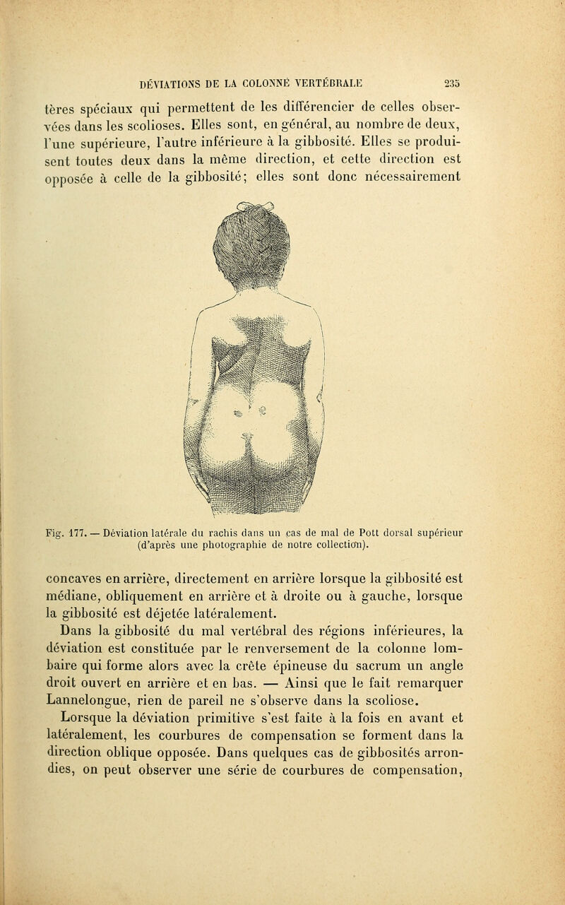 tères spéciaux qui permettent de les différencier de celles obser- vées dans les scolioses. Elles sont, en général, au nombre de deux, l'une supérieure, l'autre inférieure à la gibbosité. Elles se produi- sent toutes deux dans la même direction, et cette direction est opposée à celle de la gibbosité; elles sont donc nécessairement Fig. 177. — Déviation latérale du rachis dans un cas de mal de Pott dorsal supérieur (d'après une photographie de notre collection). concaves en arrière, directement en arrière lorsque la gibbosité est médiane, obliquement en arrière et à droite ou à gauche, lorsque la gibbosité est déjetée latéralement. Dans la gibbosité du mal vertébral des régions inférieures, la déviation est constituée par le renversement de la colonne lom- baire qui forme alors avec la crête épineuse du sacrum un angle droit ouvert en arrière et en bas. — Ainsi que le fait remarquer Lannelongue, rien de pareil ne s'observe dans la scoliose. Lorsque la déviation primitive s'est faite à la fois en avant et latéralement, les courbures de compensation se forment dans la direction oblique opposée. Dans quelques cas de gibbosités arron- dies, on peut observer une série de courbures de compensation,