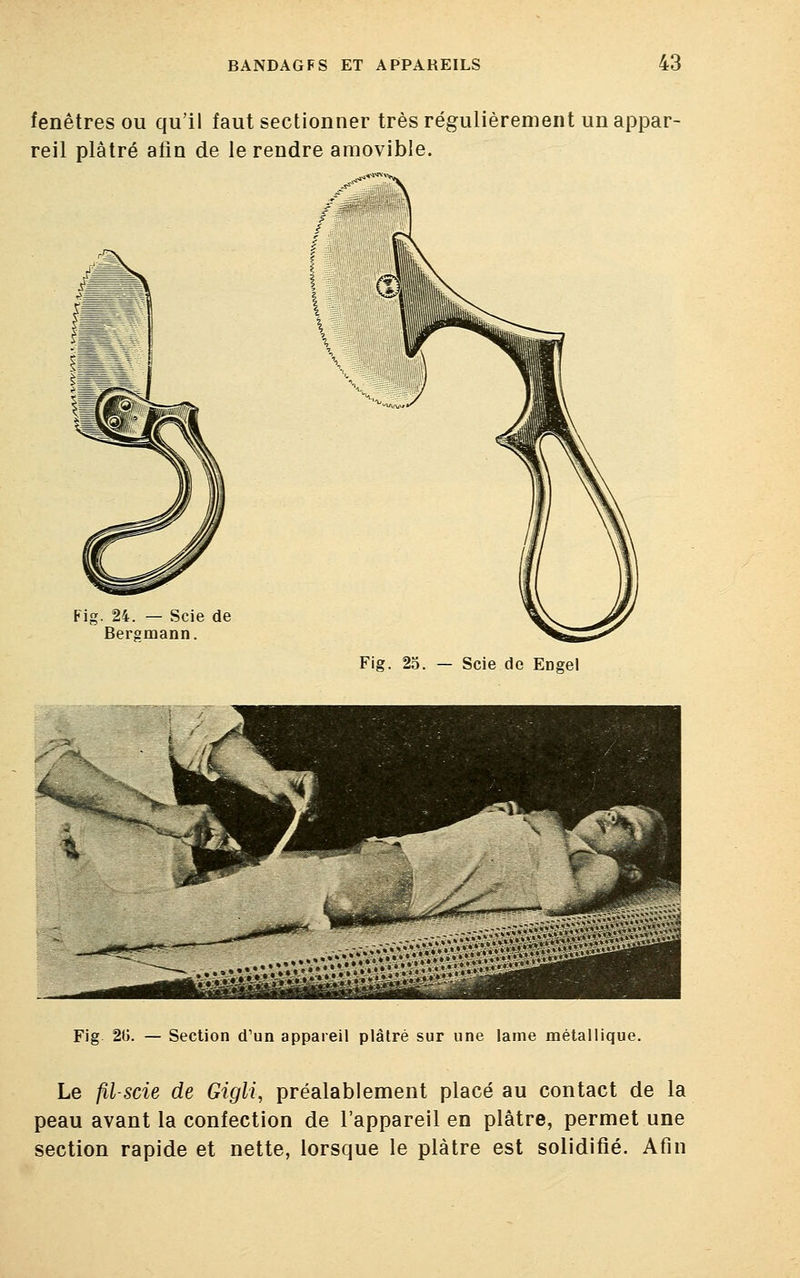 fenêtres ou qu'il faut sectionner très régulièrement un appar- reil plâtré afin de le rendre amovible. Fig. 24. — Scie de Bergmann. Fig. 25. — Scie de Eng ^^ 4 3^^v^vvvv^ Fig 20. — Section d'un appareil plâtré sur une lame métallique. Le fil-scie de Gigli, préalablement placé au contact de la peau avant la confection de l'appareil en plâtre, permet une section rapide et nette, lorsque le plâtre est solidifié. Afin