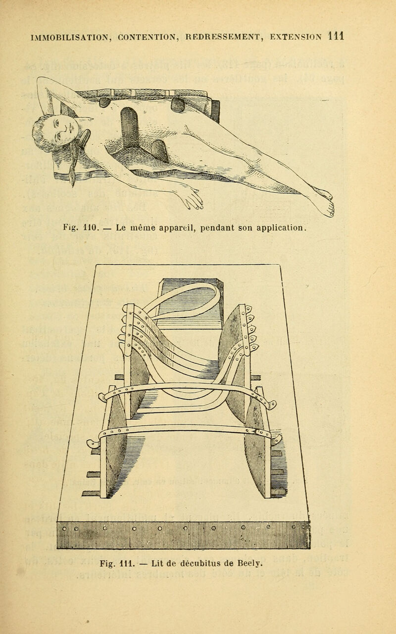 Fig. 110. — Le même appareil, pendant son application Fig. 111. — Lit de décubitus de Beely.