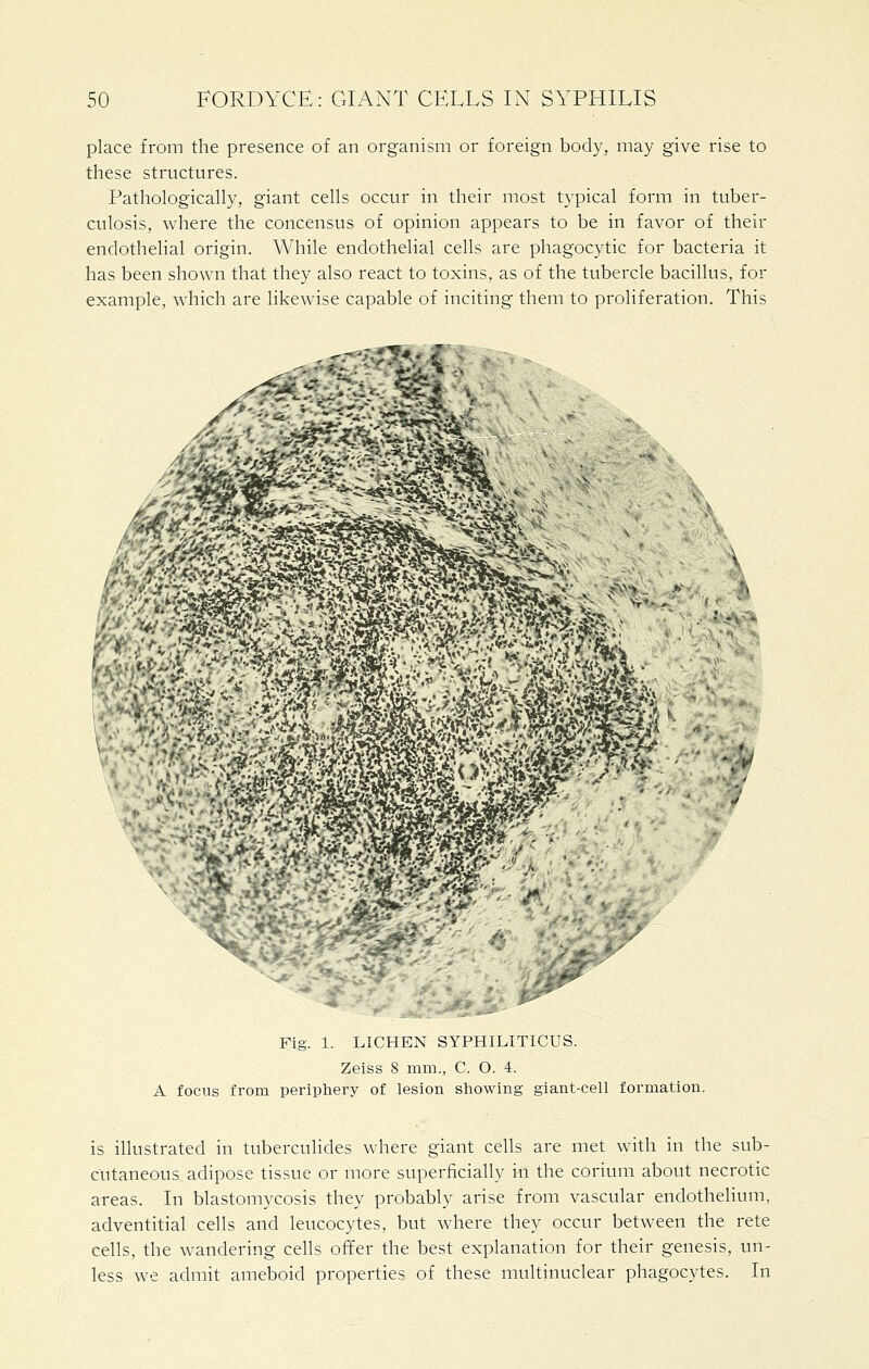 place from the presence of an organism or foreign body, may give rise to these structures. Pathologically, giant cells occur in their most typical form in tuber- culosis, where the concensus of opinion appears to be in favor of their endothelial origin. While endothelial cells are phagocytic for bacteria it has been shown that they also react to toxins, as of the tubercle bacillus, for example, which are likewise capable of inciting them to proliferation. This Fig. 1. LICHEN SYPHILITICUS. Zeiss 8 mm., C. O. 4. A focus from periphery of lesion showing giant-cell formation. is illustrated in tuberculides where giant cells are met with in the sub- cutaneous adipose tissue or more superficially in the corium about necrotic areas. In blastomycosis they probably arise from vascular endothelium, adventitial cells and leucocytes, but where they occur between the rete cells, the wandering cells offer the best explanation for their genesis, un- less we admit ameboid properties of these multinuclear phagocytes. In