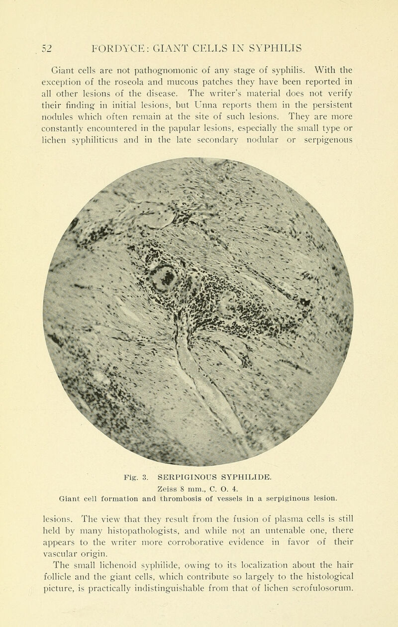 Giant cells are not pathognomonic of any stage of syphilis. With the exception of the roseola and mucous patches they have been reported in all other lesions of the disease. The writer's material does not verify their finding in initial lesions, but LTnna reports them in the persistent nodules which often remain at the site of such lesions. They are more constantly encountered in the papular lesions, especially the small type or lichen syphiliticus and in the late secondary nodular or serpigenous %^-«C '^^ «:«\ '.- Fig. 3. SERPIGINOUS SYPHILIDE. Zeiss 8 mm., C. O. 4. Giant cell formation and thrombosis of vessels in a serpiginous lesion. lesions. The view that they result from the fusion of plasma cells is still held by many histopathologists, and while not an untenable one, there appears to the writer more corroborative evidence in favor of their vascular origin. The small lichenoid syphilide, owing to its localization about the hair follicle and the giant cells, which contribute so largely to the histological picture, is practically indistinguishable from that of lichen scrofulosorum.