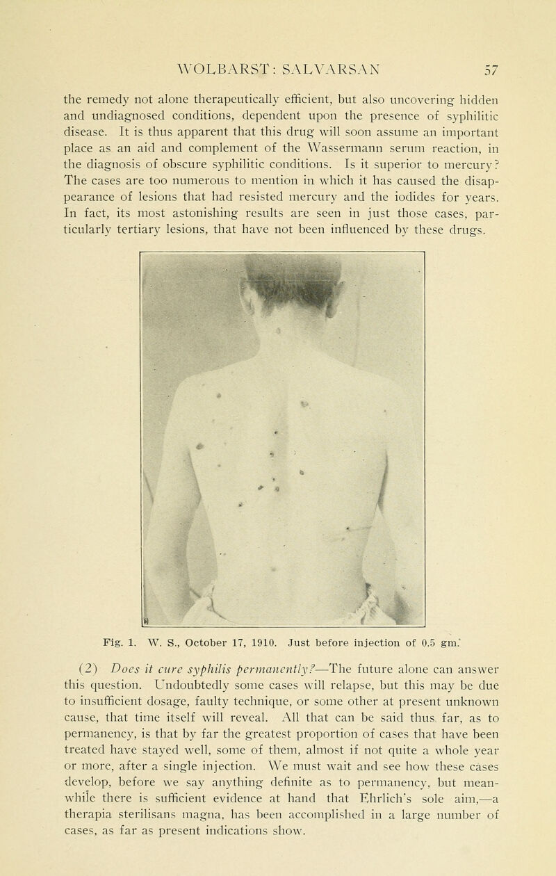 the remedy not alone therapeutically efficient, but also uncovering hidden and undiagnosed conditions, dependent upon the presence of syphilitic disease. It is thus apparent that this drug will soon assume an important place as an aid and complement of the Wassermann serum reaction, in the diagnosis of obscure syphilitic conditions. Is it superior to mercury? The cases are too numerous to mention in which it has caused the disap- pearance of lesions that had resisted mercury and the iodides for years. In fact, its most astonishing results are seen in just those cases, par- ticularly tertiary lesions, that have not been influenced by these drugs. Fig. 1. W. S., October 17, 1910. Just before injection of 0.5 gm. (2) Does it cure syphilis permanently?—The future alone can answer this question. Undoubtedly some cases will relapse, but this may be due to insufficient dosage, faulty technique, or some other at present unknown cause, that time itself will reveal. All that can be said thus far, as to permanency, is that by far the greatest proportion of cases that have been treated have stayed well, some of them, almost if not quite a whole year or more, after a single injection. We must wait and see how these cases develop, before we say anything definite as to permanency, but mean- while there is sufficient evidence at hand that Ehrlich's sole aim,—a therapia sterilisans magna, has been accomplished in a large number of cases, as far as present indications show.