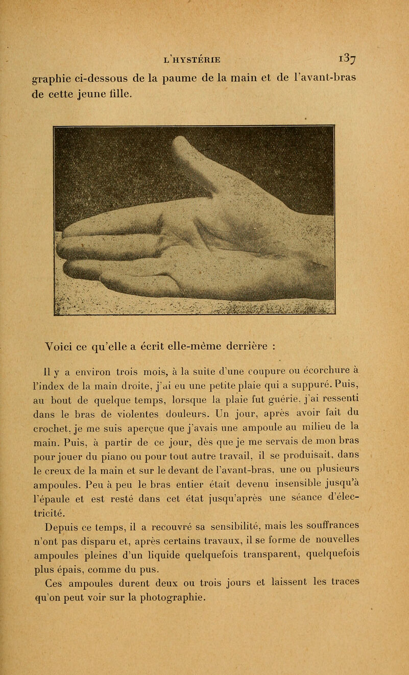 graphie ci-dessous de la paume de la main et de l'avant-bras de cette jeune fille. Voici ce qu'elle a écrit elle-même derrière 11 y a environ trois mois, à la suite d'une coupure ou écorcliure à l'index de la main droite, j'ai eu une petite plaie qui a suppuré. Puis, au bout de quelque temps, lorsque la plaie fut guérie, j'ai ressenti dans le bras de violentes douleurs. Un jour, après avoir l'ait du crochet, je me suis aperçue que j'avais une ampoule au milieu de la main. Puis, à partir de ce jour, dès que je me servais de mon bras pour jouer du piano ou pour tout autre travail, il se produisait, dans le creux de la main et sur le devant de l'avant-bras, une ou plusieurs ampoules. Peu à peu le bras entier était devenu insensible jusqu'à l'épaule et est resté dans cet état jusqu'après une séance d'élec- tricité. Depuis ce temps, il a recouvré sa sensibilité, mais les souffrances n'ont pas disparu et, après certains travaux, il se forme de nouvelles ampoules pleines d'un liquide quelquefois transparent, quelquefois plus épais, comme du pus. Ces ampoules durent deux ou trois jours et laissent les traces qu'on peut voir sur la photographie.