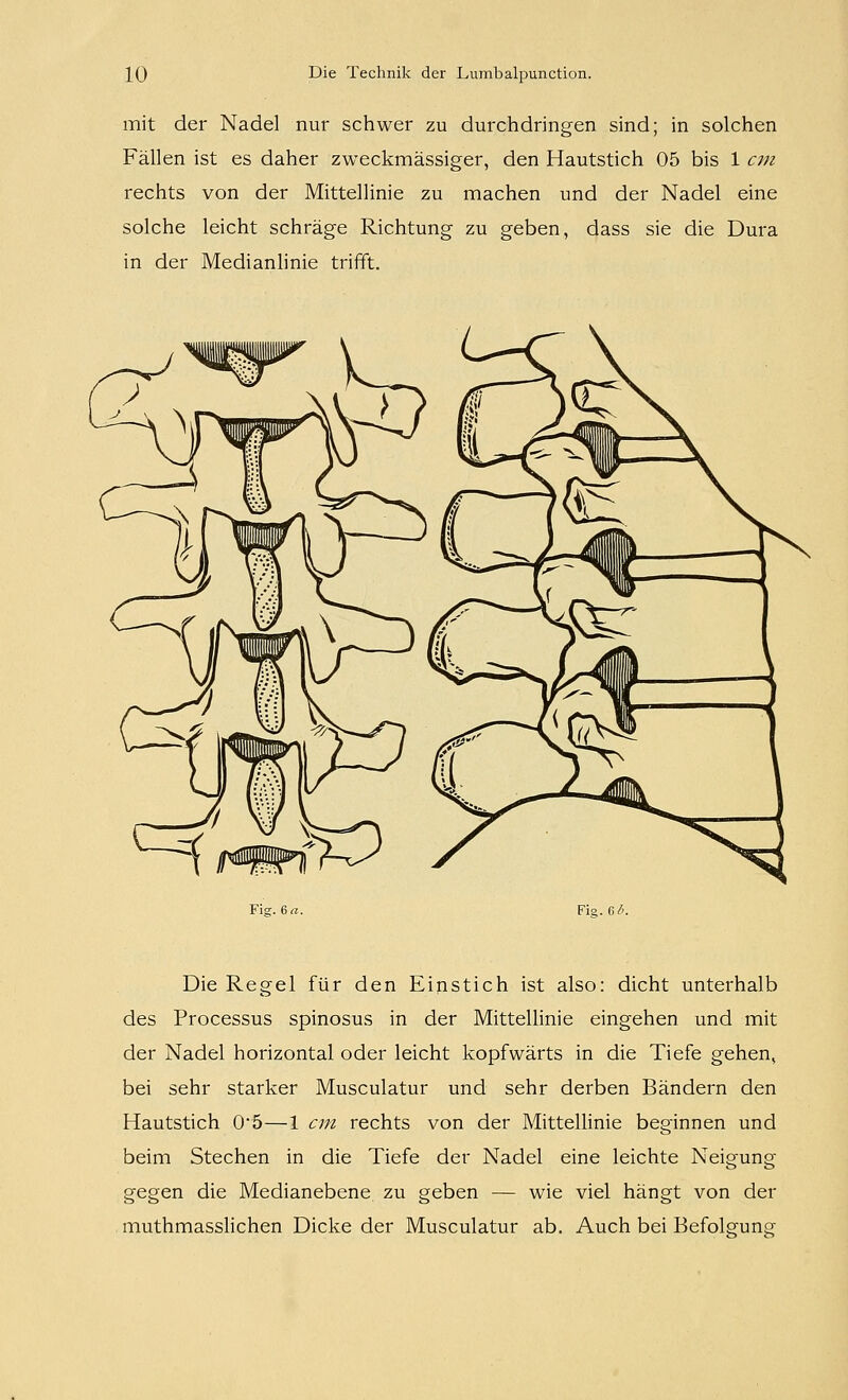 mit der Nadel nur schwer zu durchdringen sind; in solchen Fällen ist es daher zweckmässiger, den Hautstich 05 bis 1 cm rechts von der Mittellinie zu machen und der Nadel eine solche leicht schräge Richtung zu geben, dass sie die Dura in der Medianlinie triiTt. Fig. 6«. Fig. 6^. Die Regel für den Einstich ist also: dicht unterhalb des Processus spinosus in der Mittellinie eingehen und mit der Nadel horizontal oder leicht kopfwärts in die Tiefe gehen^ bei sehr starker Musculatur und sehr derben Bändern den Hautstich 05—1 cm rechts von der Mittellinie beginnen und beim Stechen in die Tiefe der Nadel eine leichte Neigung gegen die Medianebene zu geben — wie viel hängt von der muthmassHchen Dicke der Musculatur ab. Auch bei Befolgung