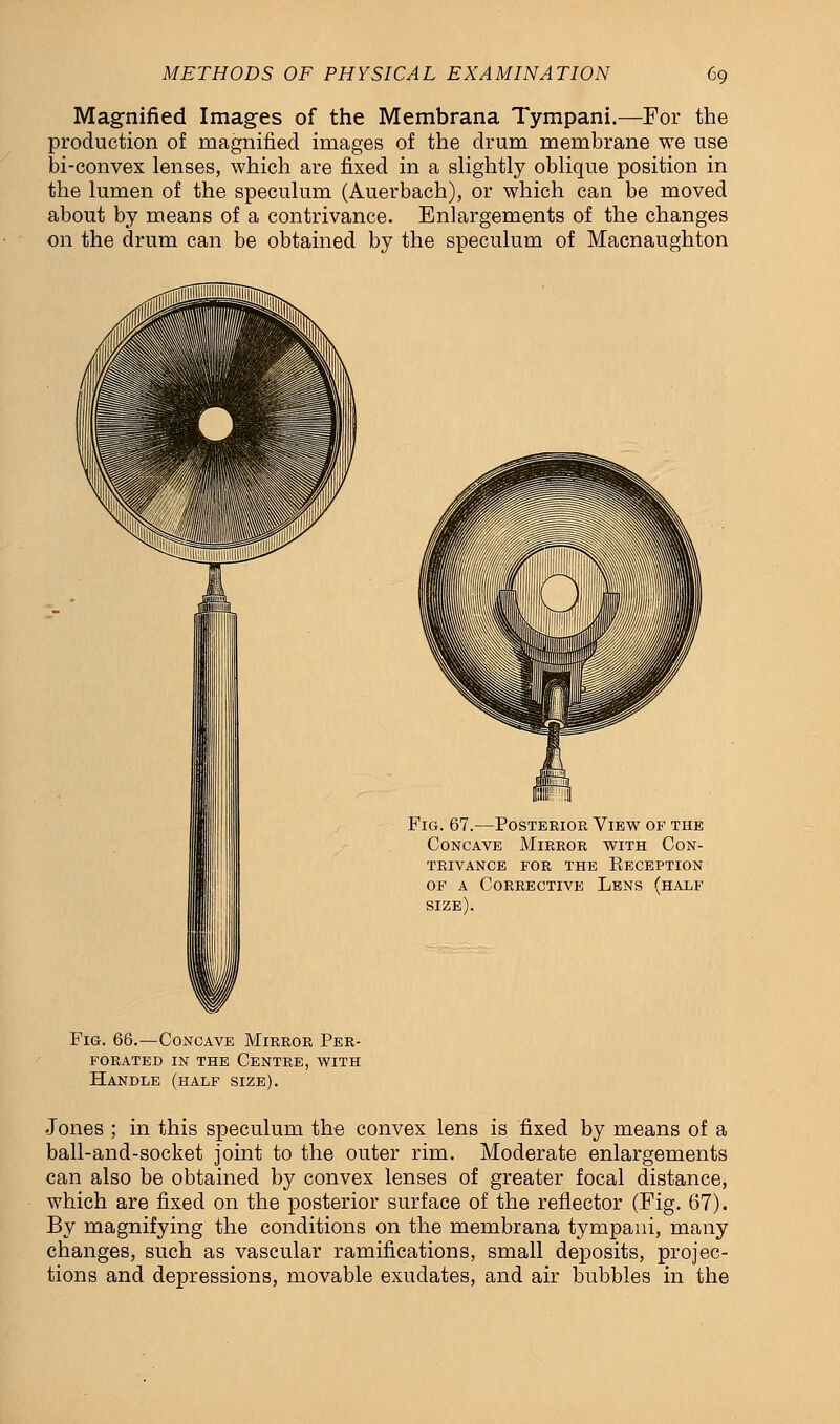 Magnified Images of the Membrana Tympani.—For the production of magnified images of the drum membrane we use bi-convex lenses, which are fixed in a slightly oblique position in the lumen of the speculum (Auerbach), or which can be moved about by means of a contrivance. Enlargements of the changes on the drum can be obtained by the speculum of Macnaughton Fig. 67.—Posterior View of the Concave Mirror with Con- trivance for the Eeception of a Corrective Lens (half size). Fig. 66.—Concave Mirror Per- forated in the Centre, with Handle (half size). Jones ; in this speculum the convex lens is fixed by means of a ball-and-socket joint to the outer rim. Moderate enlargements can also be obtained by convex lenses of greater focal distance, which are fixed on the posterior surface of the reflector (Fig. 67). By magnifying the conditions on the membrana tympani, many changes, such as vascular ramifications, small deposits, projec- tions and depressions, movable exudates, and air bubbles in the