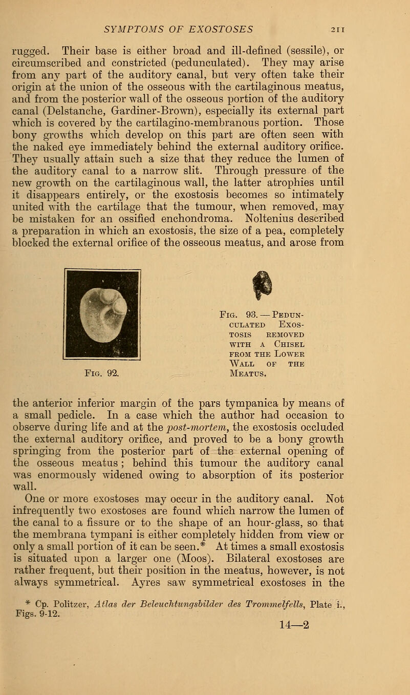 rugged. Their base is either broad and ill-defined (sessile), or circumscribed and constricted (pedunculated). They may arise from any part of the auditory canal, but very often take their origin at the union of the osseous with the cartilaginous meatus, and from the posterior wall of the osseous portion of the auditory canal (Delstanche, Gardiner-Brown), especially its external part which is covered by the cartilagino-membranous portion. Those bony growths which develop on this part are often seen with the naked eye immediately behind the external auditory orifice. They usually attain such a size that they reduce the lumen of the auditory canal to a narrow slit. Through pressure of the new growth on the cartilaginous wall, the latter atrophies until it disappears entirely, or the exostosis becomes so intimately united with the cartilage that the tumour, when removed, may be mistaken for an ossified enchondroma. Noltenius described a preparation in which an exostosis, the size of a pea, completely blocked the external orifice of the osseous meatus, and arose from Fig. 92. Fig. 93. — Pedun- culated Exos- tosis removed with a Chisel from the Lower Wall of the Meatus. the anterior inferior margin of the pars tympanic a by means of a small pedicle. In a case which the author had occasion to observe during life and at the post-mortem, the exostosis occluded the external auditory orifice, and proved to be a bony growth springing from the posterior part of the external opening of the osseous meatus; behind this tumour the auditory canal was enormously widened owing to absorption of its posterior wall. One or more exostoses may occur in the auditory canal. Not infrequently two exostoses are found which narrow the lumen of the canal to a fissure or to the shape of an hour-glass, so that the membrana tympani is either completely hidden from view or only a small portion of it can be seen.* At times a small exostosis is situated upon a larger one (Moos). Bilateral exostoses are rather frequent, but their position in the meatus, however, is not always symmetrical. Ayres saw symmetrical exostoses in the * Cp. Politzer, Atlas der Beleuclitungsbilder des Trommel/ells, Plate i., Figs. 9-12. 14—2