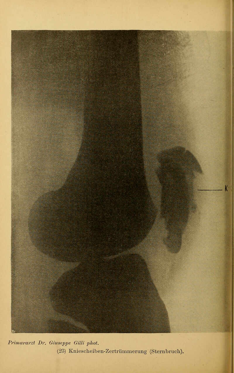 Primararzt Dr. Giuseppe Gilli pJiot. (23) Kniescheiben-Zertrümmerung (Sternbruch).