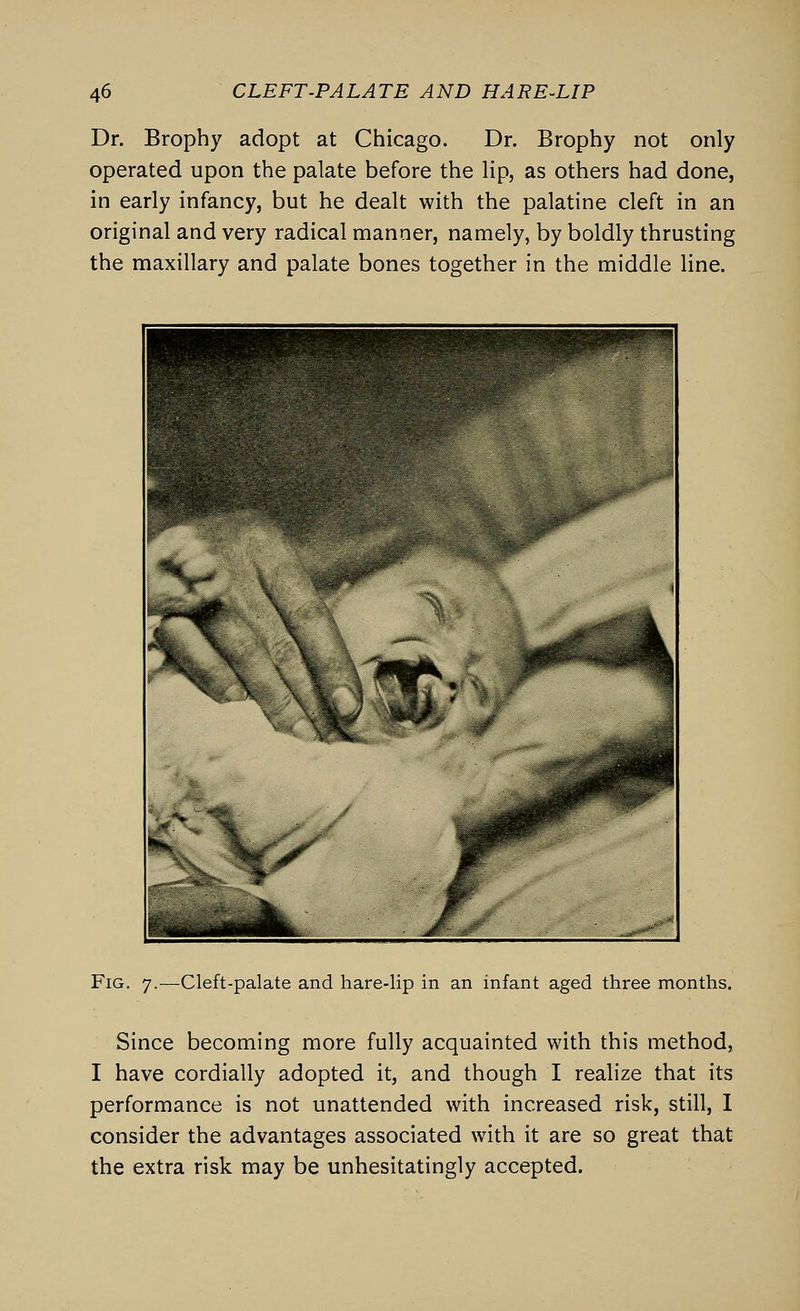 Dr. Brophy adopt at Chicago. Dr. Brophy not only operated upon the palate before the lip, as others had done, in early infancy, but he dealt with the palatine cleft in an original and very radical manner, namely, by boldly thrusting the maxillary and palate bones together in the middle line. Fig. 7.—Cleft-palate and hare-lip in an infant aged three months. Since becoming more fully acquainted with this method, I have cordially adopted it, and though I realize that its performance is not unattended with increased risk, still, I consider the advantages associated with it are so great that the extra risk may be unhesitatingly accepted.