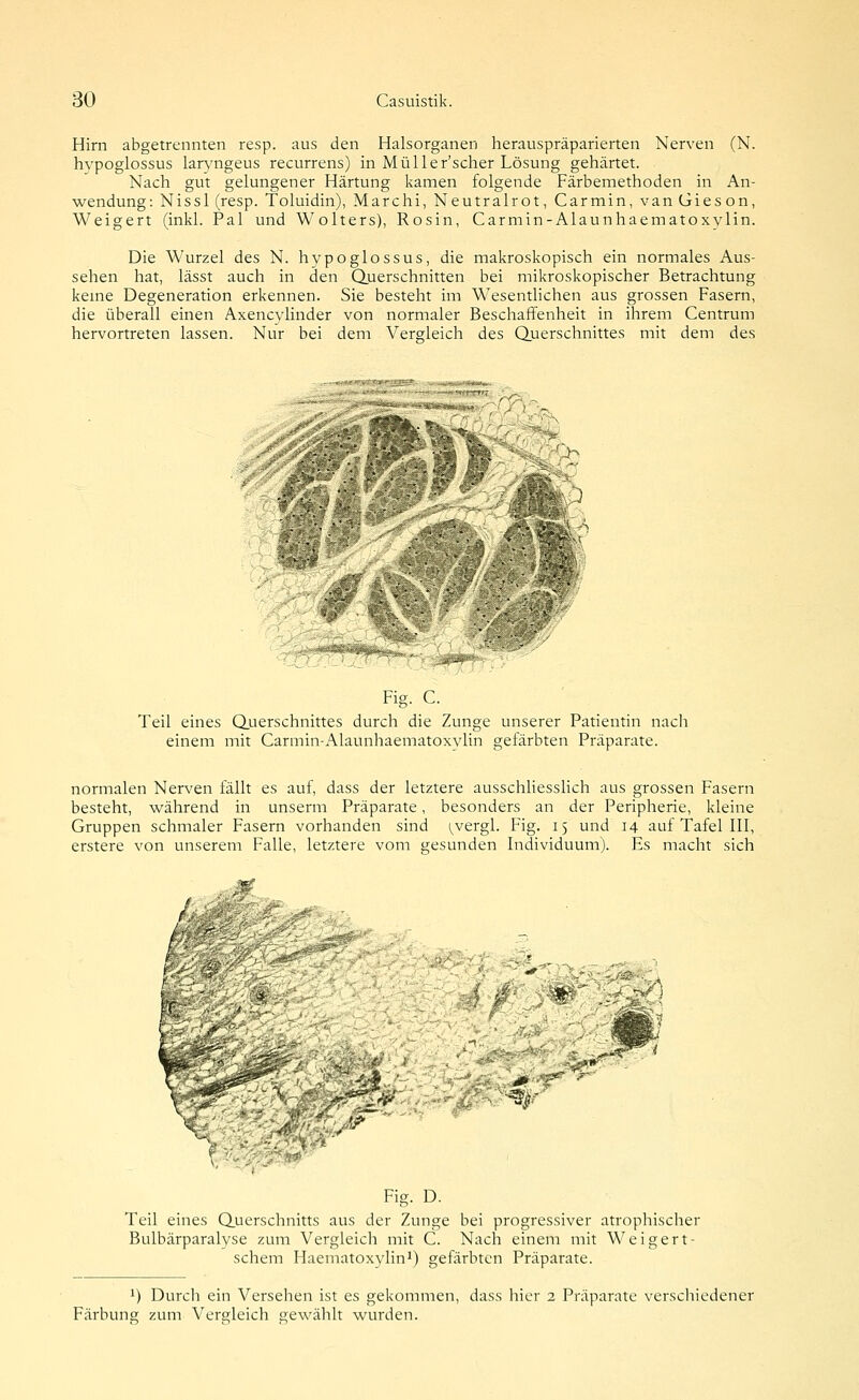 Hirn abgetrennten resp. aus den Halsorganen herauspräparierten Nerven (N. hypoglossus larv'ngeus recurrens) in Müller'scher Lösung gehärtet. Nach gut gelungener Härtung kamen folgende Färbemethoden in An- wendung: Nissl (resp. Toluidin), Marchi, Neutralrot, Carmin, vanGieson, Weigert (inkl. Pal und Wolters), Rosin, Carmin-Alaunhaematoxvlin. Die Wurzel des N. hypoglossus, die makroskopisch ein normales Aus- sehen hat, lässt auch in den Querschnitten bei mikroskopischer Betrachtung kerne Degeneration erkennen. Sie besteht im Wesentlichen aus grossen Fasern, die überall einen Axencylinder von normaler Beschaffenheit in ihrem Centrum hervortreten lassen. Nur bei dem Vergleich des Querschnittes mit dem des .^>^i IS S^ Fig. C. Teil eines Q.uerschnittes durch die Zunge unserer Patientin nach einem mit Carmin-Alaunhaematoxvlin gefärbten Präparate. normalen Nerven fällt es auf, dass der letztere ausschliesslich aus grossen Fasern besteht, während in unserm Präparate, besonders an der Peripherie, kleine Gruppen schmaler Fasern vorhanden sind i^vergl. Fig. 15 und 14 auf Tafel III, erstere von unserem Falle, letztere vom gesunden Individuum). Es macht sich K ,v^ Fig. D. Teil eines Querschnitts aus der Zunge bei progressiver atrophischer Bulbärparalyse zum Vergleich mit C. Nach einem mit Weigert- schem Haematoxylin^) gefärbten Präparate. 1) Durch ein Versehen ist es gekommen, dass hier 2 Präparate verschiedener Färbung zum Vergleich gewählt wurden.