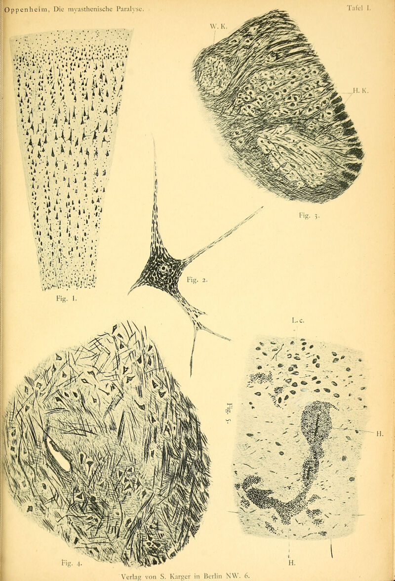 Oppenheim, Die m^'asthenische Paralyse. I ..- -v .' ' •! .'/Vj \t *!-',•;'. •;.-« •*. •' *• [■ ■■ ;• -^ 4 ^ ':■■;-■ i'r>iy;i Fig. 1, l'afel 1. ^' X Fig. 3. L.c. IT ^^ '.. ^^^ 1» i ~ H. 'S..- H.