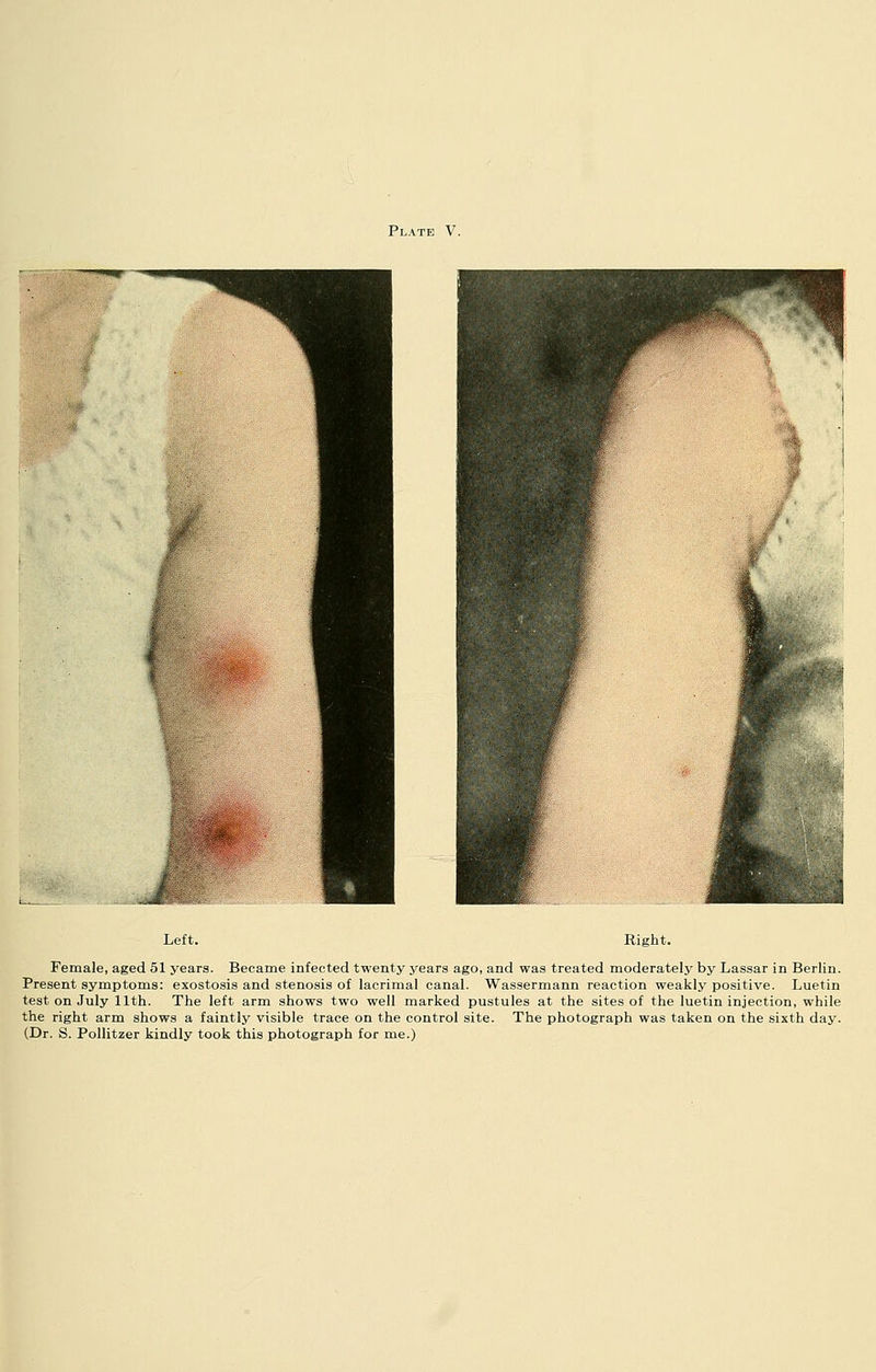 Right. Female, aged 51 years. Became infected twenty years ago, and was treated moderately by Lassar in Berlin. Present symptoms: exostosis and stenosis of lacrimal canal. Wassermann reaction weakly positive. Luetin test on July 11th. The left arm shows two well marked pustules at the sites of the luetin injection, while the right arm shows a faintly visible trace on the control site. The photograph was taken on the sixth day. (Dr. S. PoUitzer kindly took this photograph for me.)