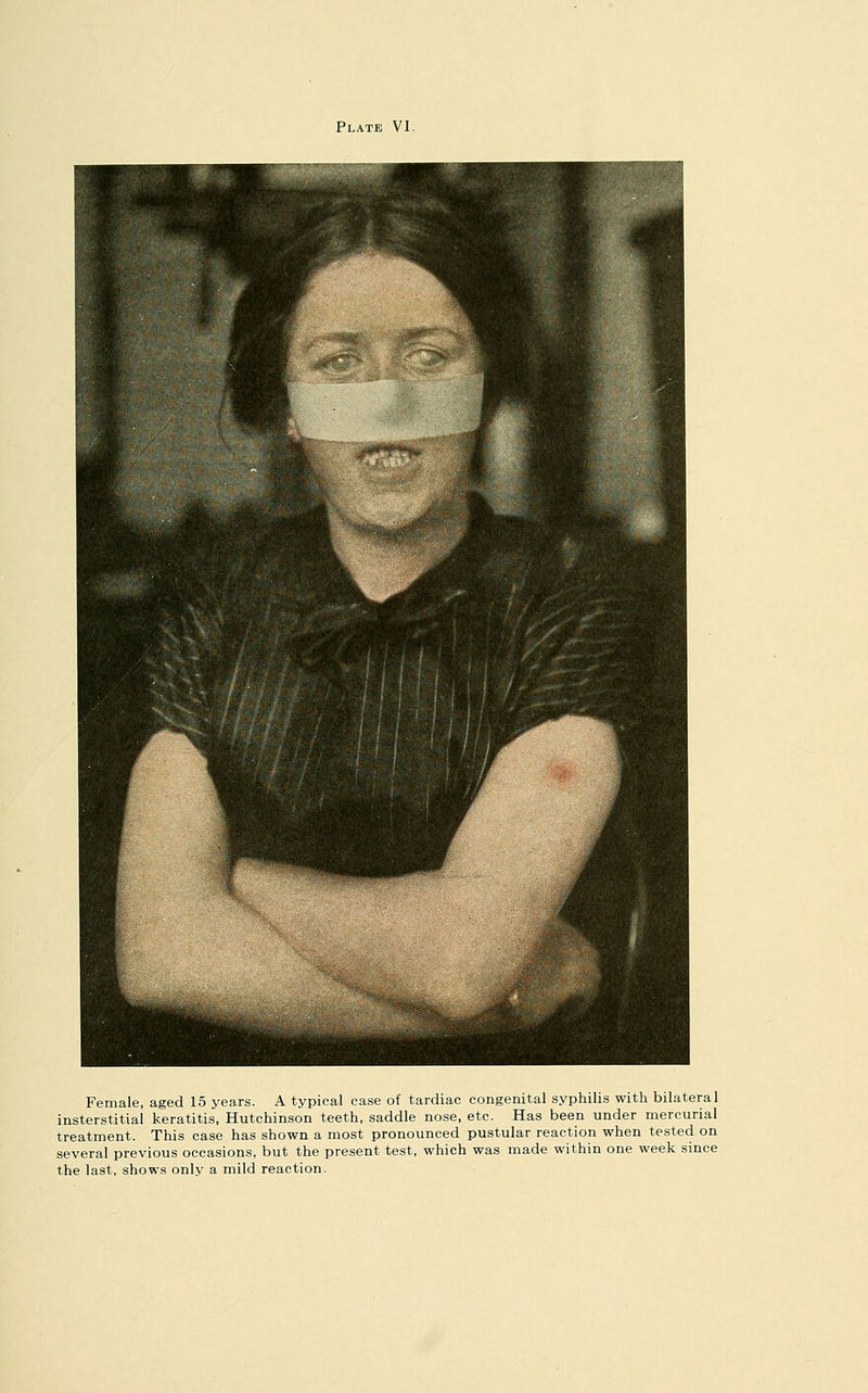 Female, aged 15 years. A typical case of tardiac congenital syphilis with bilateral insterstitial keratitis, Hutchinson teeth, saddle nose, etc. Has been under mercurial treatment. This case has shown a most pronounced pustular reaction when tested on several previous occasions, but the present test, which was made within one week since the last, shows only a mild reaction.