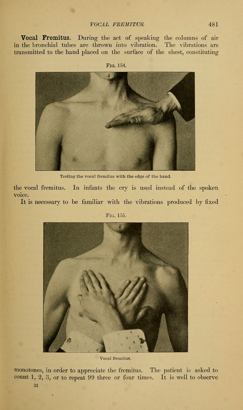 Vocal Fremitus. During the act of speaking the columns of air in the bronchial tubes are thrown into vibration. The vibrations are transmitted to the hand placed on the surface of the chest, constituting Testing the vocal fremitus with the edge of the hand. the vocal fremitus. In infants the cry is used instead of the spoken voice. It is necessary to be familiar with the vibrations produced by fixed Fig. 155. Vocal fremitus. monotones, in order to appreciate the fremitus. The patient is asked to count 1, 2, 3, or to repeat 99 three or four times. It is well to observe