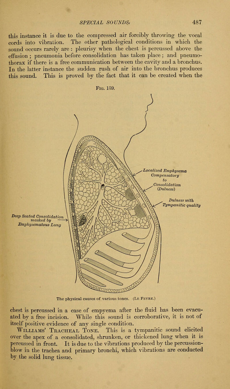 this instance it is due to the compressed air forcibly throwing the vocal cords into vibration. The other pathological conditions in which the sound occurs rarely are : pleurisy when the chest is percussed above the effusion ; pneumonia before consolidation has taken place ; and pneumo- thorax if there is a free communication between the cavity and a bronchus. In the latter instance the sudden rush of air into the bronchus produces this sound. This is proved by the fact that it can be created when the Localized Emphysema Deep Seated Consolidation masked by — Emphysematous Lung Dulness with Tympanitic quality The physical causes of various tones. (Le Fevre.) chest is percussed in a case of empyema after the fluid has been evacu- ated by a free incision. While this sound is corroborative, it is not of itself positive evidence of any single condition. Williams' Tracheal Tone. This is a tympanitic sound elicited over the apex of a consolidated, shrunken, or thickened lung when it is percussed in front. It is due to the vibrations produced by the percussion- blow in the trachea and primary bronchi, which vibrations are conducted by the solid lung tissue.