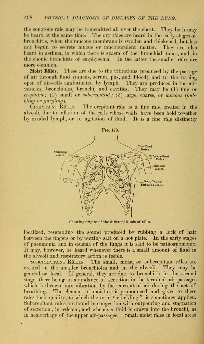 the sonorous rale may be transmitted all over the chest. They both may be heard at the same time. The dry rales arc heard in the early stages of bronchitis, when the mucous membrane is swollen and thickened, but has qoI begun t<» secrete iniiens <»r mucopurulent matter. 'They are also heard in asthma, in which there is spasm of the bronchial tubes, and in the chonio bronchitis of emphysema. In the latter the smaller rales are more common. Moist Rales. These are due to the vibrations produced by the passage of air through fluid (mucus, serum, pus, and blood), and to the forcing open of air-cells agglutinated by lymph. They are produced in the air- vesicle-, bronchioles, bronchi, and cavities. They may be (1) fine or <-nj,//<int; (J) small or mharpiUmi; (?>) large, coarse, or mucous (bub- bling or gurgling). CREPITANT R&LES. The crepitant rale is a fine rale, created in the alveoli, due to inflation of the cells whose walls have been held together by exuded lymph, or to agitation of fluid. It is a fine rale distinctly Showing origins of the different kinds of r&les. localized, resembling the sound produced by rubbing a lock of hair between the fingers or by putting salt on a hot plate. In the early stages of pneumonia and in oedema of the lungs it is said to be pathognomonic. It may, however, be heard whenever there is a small amount of fluid in the alveoli and respiratory action is feeble. Subceepitant Raxes. The small, moist, or subcrepitant rales are created in the smaller bronchioles and in the alveoli. They may be general or local. If general, they are due to bronchitis in the second stage, there being an abundance of secretion in the terminal air-passages which is thrown into vibration by the current of air during the act of breathing. The element of moisture is pronounced and gives to these rales their quality, to which the term  crackling  is sometimes applied. Subcrepitant rales are found in congestion with outpouring and stagnation of secretion ; in oedema; and whenever fluid is drawn into the bronchi, as in hemorrhage of the upper air-passages. Small moist rales in local areas