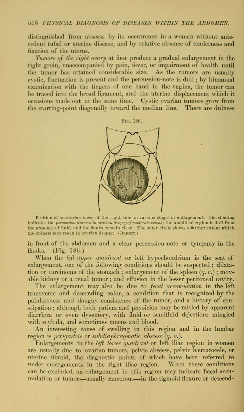 distinguished from abscess by ita occurrence in a woman without ante- cedenl tubal <>r uterine disease, and by relative absence of tenderness and fixation of the uterus. Tumors of tin ri<//it ovary al firsl produce a gradual enlargement in the right groin, unaccompanied by pain, fever, or impairment of health until the mi • has attained considerable size. As the tumors are usually cystic, fluctuation is presenl and the percussion-note Is dull; by bimanual examination with 111«- Angers of one hand in the vagina, the tumor can be traced into the broad ligament, and the uterine displacement which it occasions made ou1 :it the Bame time. Cystic ovarian tumors grow from the starting-poinl diagonally toward the median line. There are dulness Fig. 186. Position of an ovarian tumor of the right side in various stages of enlargement. The shading indicates the percwtsion-dulness in ovarian dropsy of moderate extent; the umbilical region is dull from the presence of fluid, and the flanks remain clear. The outer circle shows a farther extent which the dulness may reach in ovarian dropsy. (Beight.) in front of the abdomen and a clear percussion-note or tympany in the flanks. (Fig. 186.) When the left upper quadrant or left hypochondrium is the seat of enlargement, one of the following conditions should be suspected.: dilata- tion or carcinoma of the stomach ; enlargement of the spleen (q. v.); mov- able kidney or a renal tumor; and effusion in the lesser peritoneal cavity. The enlargement may also be due to fecal accumulation in the left transverse and descending colon, a condition that is recognized by the painlessness and doughy consistence of the tumor, and a history of con- stipation ; although both patient and physician may be misled by apparent diarrhoea or even dysentery, with fluid or semifluid dejections mingled with scybala, and sometimes mucus and blood. An interesting cause of swelling in this region and in the lumbar region is perigastric or subdiaphragmatic abscess (q. v.). Enlargements in the left lover quadrant or left iliac region in women are usually due to ovarian tumors, pelvic abscess, pelvic hematocele, or uterine fibroid, the diagnostic points of which have been referred to under enlargements in the right iliac region. When these conditions can be excluded, an enlargement in this region may indicate faecal accu- mulation or tumor—usually cancerous—in the sigmoid flexure or descend-