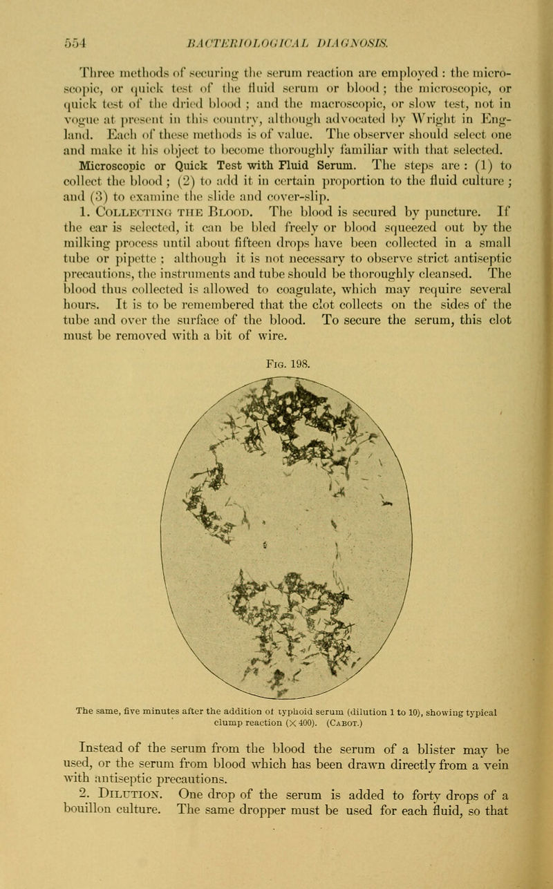 Three methods of securing the serum reaction are employed : themicro- Bcopic, or quick test of the fluid serum or blood; the microscopic, or quick tesi of the dried blood ; and the macroscopic, or slow test, not in vogue ;it present in tin- country, although advocated by Wright in Eng- land. Bach of these methods is of value. The observer should select one ami make it his object to become thoroughly familiar with that selected. Microscopic or Quick Test with Fluid Serum. The steps are : (1) to collect the blood ; (2) to add it in certain proportion to the fluid culture; ami (■.) to examine the slide and cover-slip. 1. COLLECTING THE BLOOD. The blood is secured by puncture. If the ear is selected, it can be bled freely or blood squeezed out by the milking process until about fifteen drops have been collected in a small tube or pipette : although it is not necessary to observe strict antiseptic precautions, the instruments and tube should be thoroughly cleansed. The blood thus collected is allowed to coagulate, which may require several hours. It is to be remembered that the clot collects on the sides of the tube and over the surface of the blood. To secure the serum, this clot must be removed with a bit of wire. Fig. 198. The same, five minutes after the addition of typhoid serum (dilution 1 to 10), showing typical clump reaction (X 400). (Cabot.) Instead of the serum from the blood the serum of a blister may be used, or the serum from blood which has been drawn directly from a Vein with antiseptic precautions. 2. Dilution. One drop of the serum is added to forty drops of a bouillon culture. The same dropper must be used for each fluid, so that