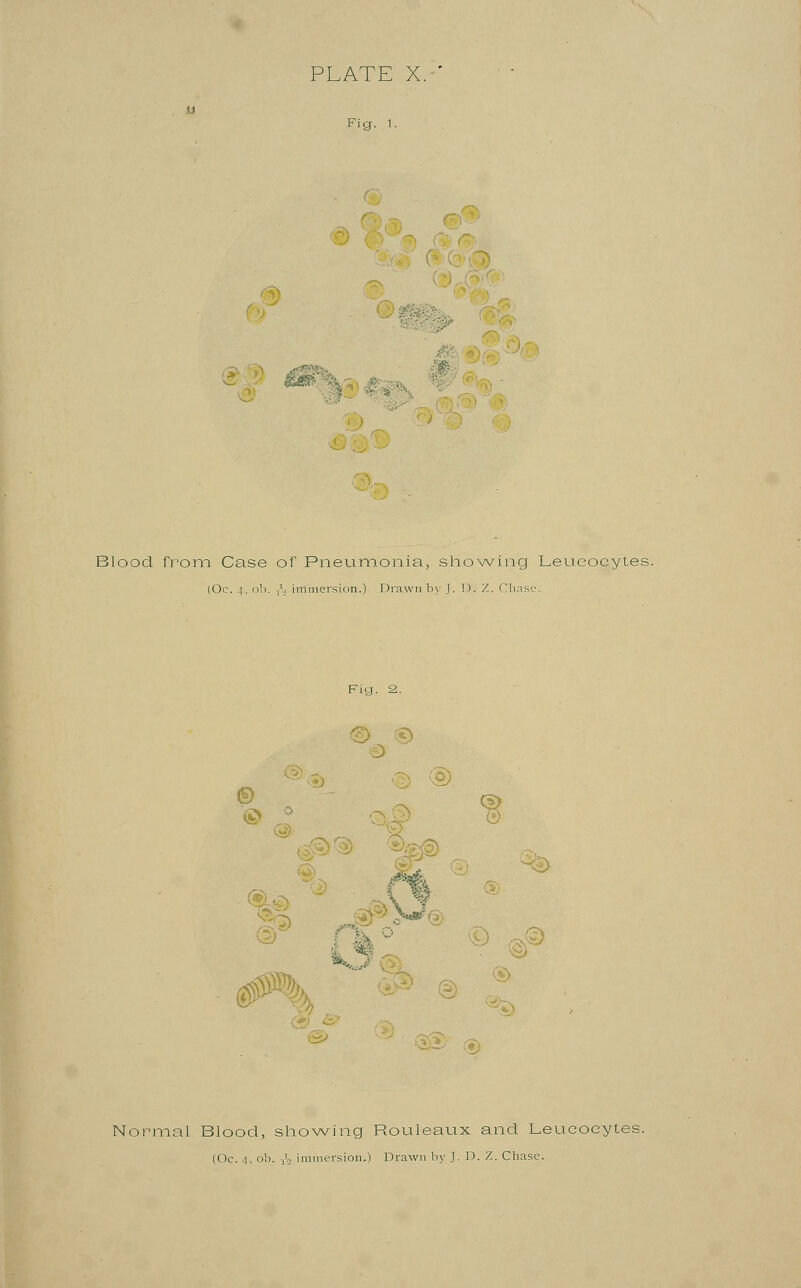 Blood from Case of Pneumonia, showing Leucocytes #\ Normal Blood, showing Rouleaux and Leucocytes (Oc. 4, ob. J2 immersion.) Drawn by J. D. Z. Chase.