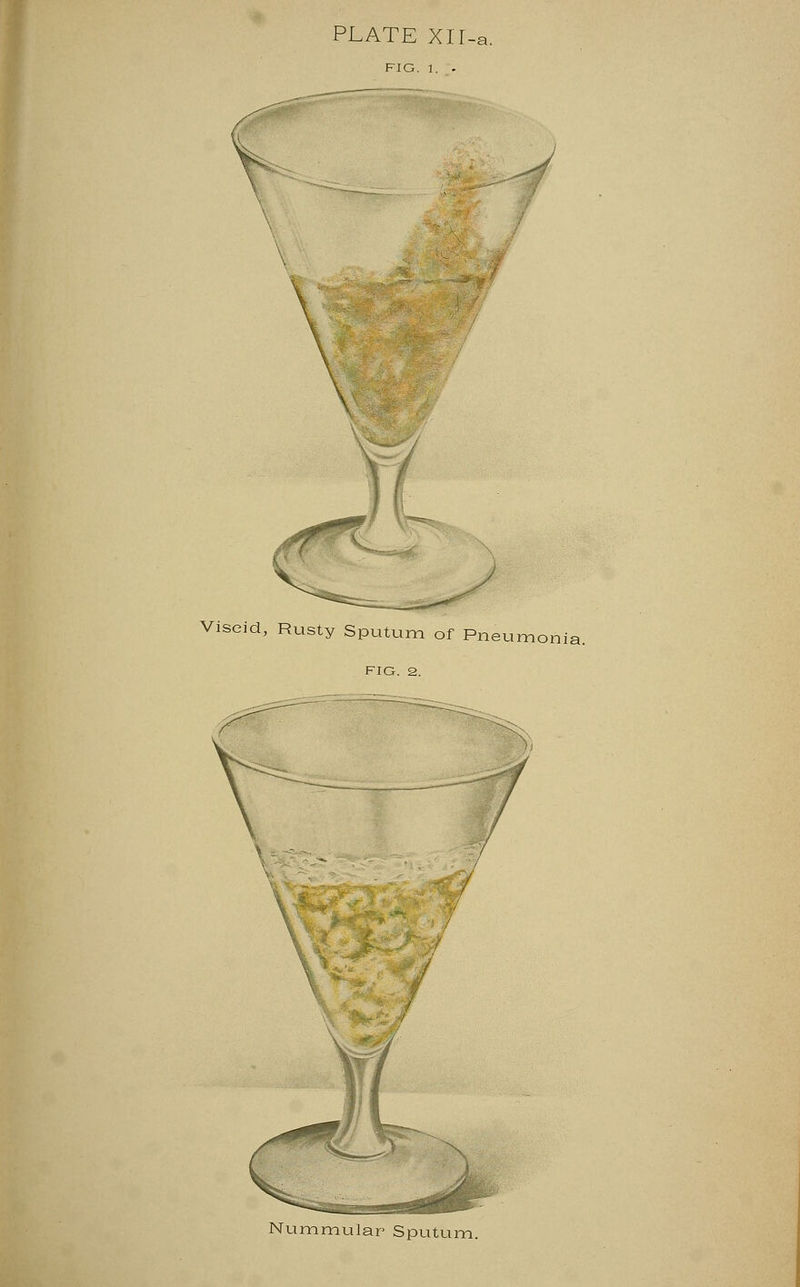 PLATE Xir-a. FIG. 1. . Viscid, Rusty Sputum of Pneumonia. FIG. 2. 7 Nummular Sputum.