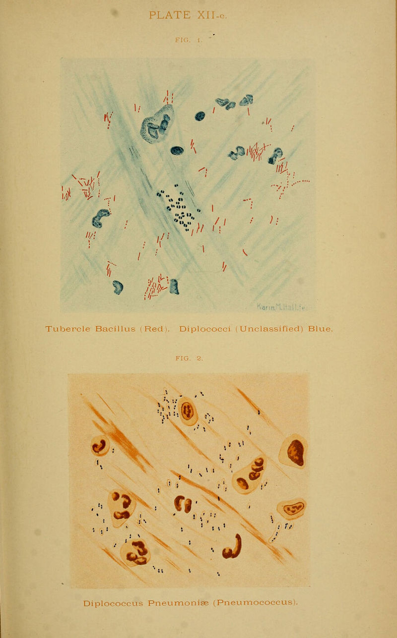 PLATE XII- l i >4 VL,, H/i iifj, r'» 1! / / J •' t |pl Tubercle Bacillus (Red). Diploeocei (Unclassified) Blue. 'M ,, ^ i % 3 Diplocoecus Pneumoniae (Pneumoeoeeus).