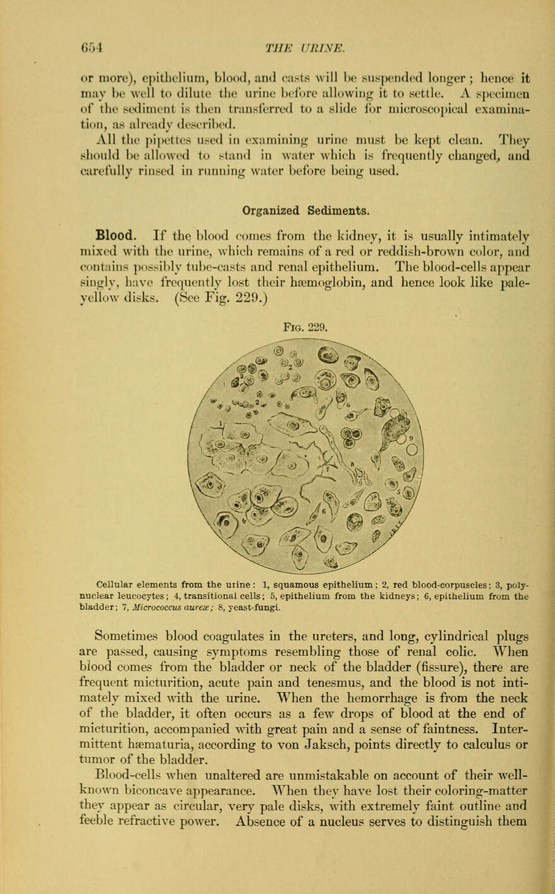 or more), epithelium, blood, and caste will be suspended longer; hence it may be well to dilute the urine before allowing it to settle. A specimen of the sediment is then transferred to a slide for microscopical examina- tion, as already described. All the pipettes used in examining urine must he kept clean. They should he allowed to stand in water which is frequently changed, and carefully rinsed in running water hefbre being used. Organized Sediments. Blood. If the blood comes from the kidney, it is usually intimately mixed with the urine, which remains of a red or reddish-brown color, and contains possibly tube-casts and renal epithelium. The blood-cells appear singly, have frequently lost their hemoglobin, and hence look like pale- yellow disks. (See Fig. 229.) Cellular elements from the urine : 1, squamous epithelium; 2, red blood-corpuscles; 3, poly- nuclear leucocytes; 4, transitional cells; 5, epithelium from the kidneys; 6, epithelium from the bladder; 7, Micrococcus aureas; 8, yeast-fungi. Sometimes blood coagulates in the ureters, and long, cylindrical plugs are passed, causing symptoms resembling those of renal colic. When blood comes from the bladder or neck of the bladder (fissure), there are frequent micturition, acute pain and tenesmus, and the blood is not inti- mately mixed with the urine. When the hemorrhage is from the neck of the bladder, it often occurs as a few drops of blood at the end of micturition, accompanied with great pain and a sense of faintness. Inter- mittent hematuria, according to von Jaksch, points directly to calculus or tumor of the bladder. Blood-cells when unaltered are unmistakable on account of their well- known biconcave appearance. When they have lost their coloring-matter they appear as circular, very pale disks, with extremely faint outline and feeble refractive power. Absence of a nucleus serves to distinguish them