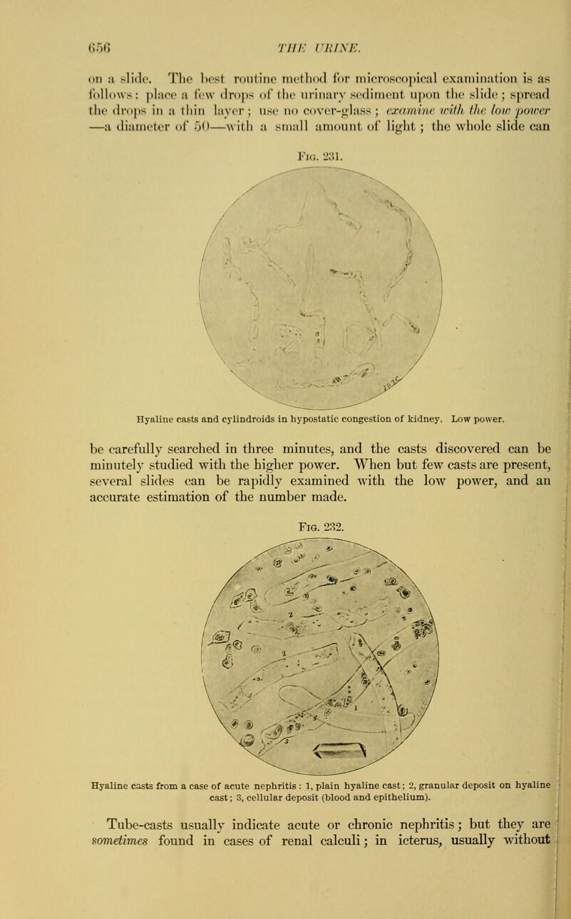 on ;i slide. The best routine method for microscopical examination is us follows: place a few drops of the urinary sediment upon the slide; spread the drops in a thin layer\ use do cover-glass; examine with the Ion- power —a diameter of 50—with a small amount of light; the whole slide can ■*'-y Hyaline casts and cylindroids in hypostatic congestion of kidney. Low power. be carefully searched in three minutes, and the casts discovered can be minutely studied with the higher power. When but few casts are present, several slides can be rapidly examined with the low power, and an accurate estimation of the number made. Fig. 232. Hyaline casts from a ease of acute nephritis : 1, plain hyaline cast; 2, granular deposit on hyaline cast; 3, cellular deposit (blood and epithelium). Tube-casts usually indicate acute or chronic nephritis; but they are sometimes found in cases of renal calculi; in icterus, usually without