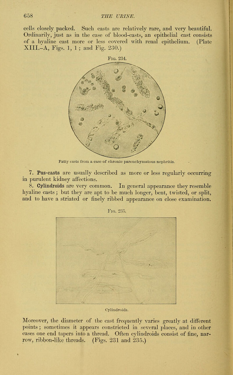 cells closely packed. Such casts are relatively rare, and very beautiful. Ordinarily, just as in the case of blood-casts, an epithelial cast consists of a hyaline cast more or less covered with renal epithelium. (Plate XIII.-A, Figs. 1, 1 ; and Fig. 230.) Fatty casts from a case of chronic parenchymatous neph 7. Pus-casts are usually described as more or less regularly occurring in purulent kidney affections. 8. Cylindroids are very common. In general appearance they resemble hyaline casts; but they are apt to be much longer, bent, twisted, or split, and to have a striated or finely ribbed appearance on close examination. Moreover, the diameter of the cast frequently varies greatly at different points; sometimes it appears constricted in several places, and in other cases one end tapers into a thread. Often cylindroids consist of fine, nar- row, ribbon-like threads. (Figs. 231 and 235.)