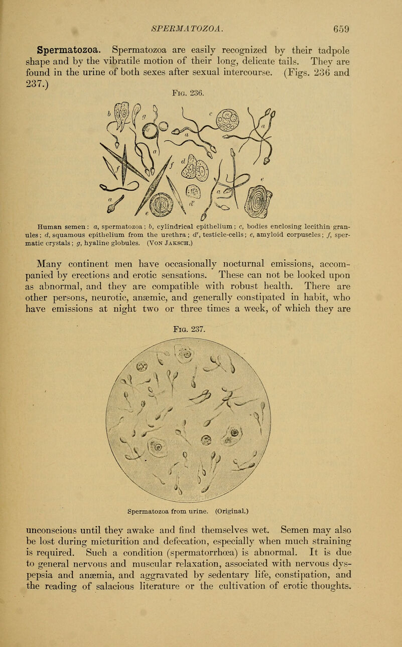 Spermatozoa. Spermatozoa are easily recognized by their tadpole shape and by the vibratile motion of their long, delicate tails. They are found in the urine of both sexes after sexual intercourse. (Figs. 236 and 237.) Fig. 236. Human semen: a, spermatozoa; b, cylindrical epithelium; c, bodies enclosing lecithin gran- ules; d, squamous epithelium from the urethra; d', testicle-cells; e, amyloid corpuscles; /, sper- matic crystals; g, hyaline globules. (Von Jaksch.) Many continent men have occasionally nocturnal emissions, accom- panied by erections and erotic sensations. These can not be looked upon as abnormal, and they are compatible with robust health. There are other persons, neurotic, anaemic, and generally constipated in habit, who have emissions at night two or three times a week, of which they are Fig. 237. Spermatozoa from urine. (Original.) unconscious until they awake and find themselves wet. Semen may also be lost during micturition and defecation, especially when much straining is required. Such a condition (spermatorrhoea) is abnormal. It is due to general nervous and muscular relaxation, associated with nervous dys- pepsia and anaemia, and aggravated by sedentary life, constipation, and the reading of salacious literature or the cultivation of erotic thoughts.