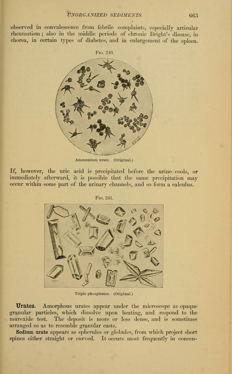 observed in convalescence from febrile complaints, especially articular rheumatism ; also in the middle periods of chronic Bright's disease, in chorea, in certain types of diabetes, and in enlargement of the spleen. Ammonium urate. (Original.) If, however, the uric acid is precipitated before the urine cools, or immediately afterward, it is possible that the same precipitation may occur within some part of the urinary channels, and so form a calculus. Triple phosphates. (Original.) Urates. Amorphous urates appear under the microscope as opaque granular particles, which dissolve upon heating, and respond to the murexide test. The deposit is more or less dense, and is sometimes arranged so as to resemble granular casts. Sodium urate appears as spherules or globules, from which project short spines either straight or curved. It occurs most frequently in concen-