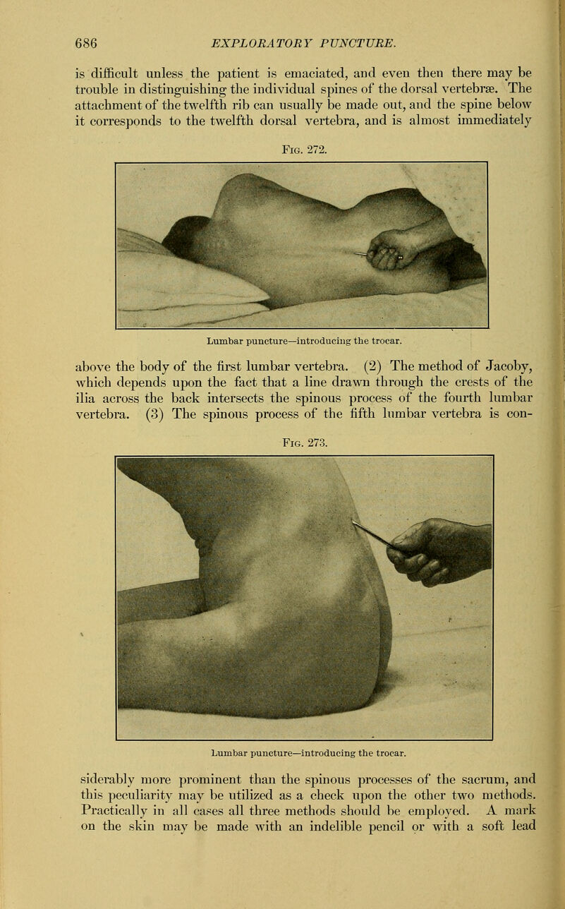 is difficult unless the patient is emaciated, and even then there may be trouble in distinguishing the individual spines of the dorsal vertebrae. The attachment of the twelfth rib can usually be made out, and the spine below it corresponds to the twelfth dorsal vertebra, and is almost immediately Lumbar puncture—introducing the trocar. above the body of the first lumbar vertebra. (2) The method of Jacoby, which depends upon the fact that a line drawn through the crests of the ilia across the back intersects the spinous process of the fourth lumbar vertebra. (3) The spinous process of the fifth lumbar vertebra is con- Lumbar puncture—introducing the trocar. siderably more prominent than the spinous processes of the sacrum, and this peculiarity may be utilized as a check upon the other two methods. Practically in all cases all three methods should be employed. A mark on the skin may be made with an indelible pencil or with a soft lead