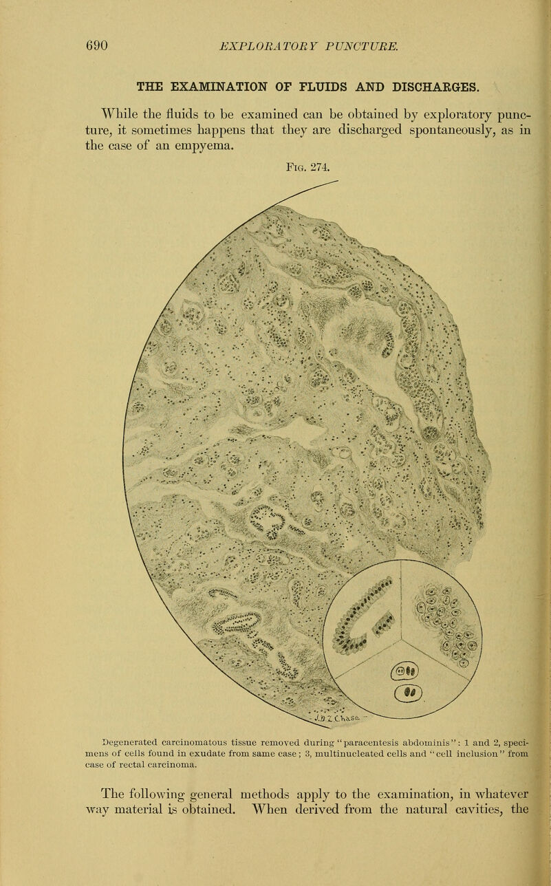 THE EXAMINATION OF FLUIDS AND DISCHARGES. While the fluids to be examined can be obtained by exploratory punc- ture, it sometimes happens that they are discharged spontaneously, as in the case of an empyema. Degenerated carcinomatous tissue removed during paracentesis abdominis: 1 and 2, speci- ens of ceils found in exudate from same case; 3, multinucleated cells and  cell inclusion  from se of rectal carcinoma. The following general methods apply to the examination, in whatever way material is obtained. When derived from the natural cavities, the