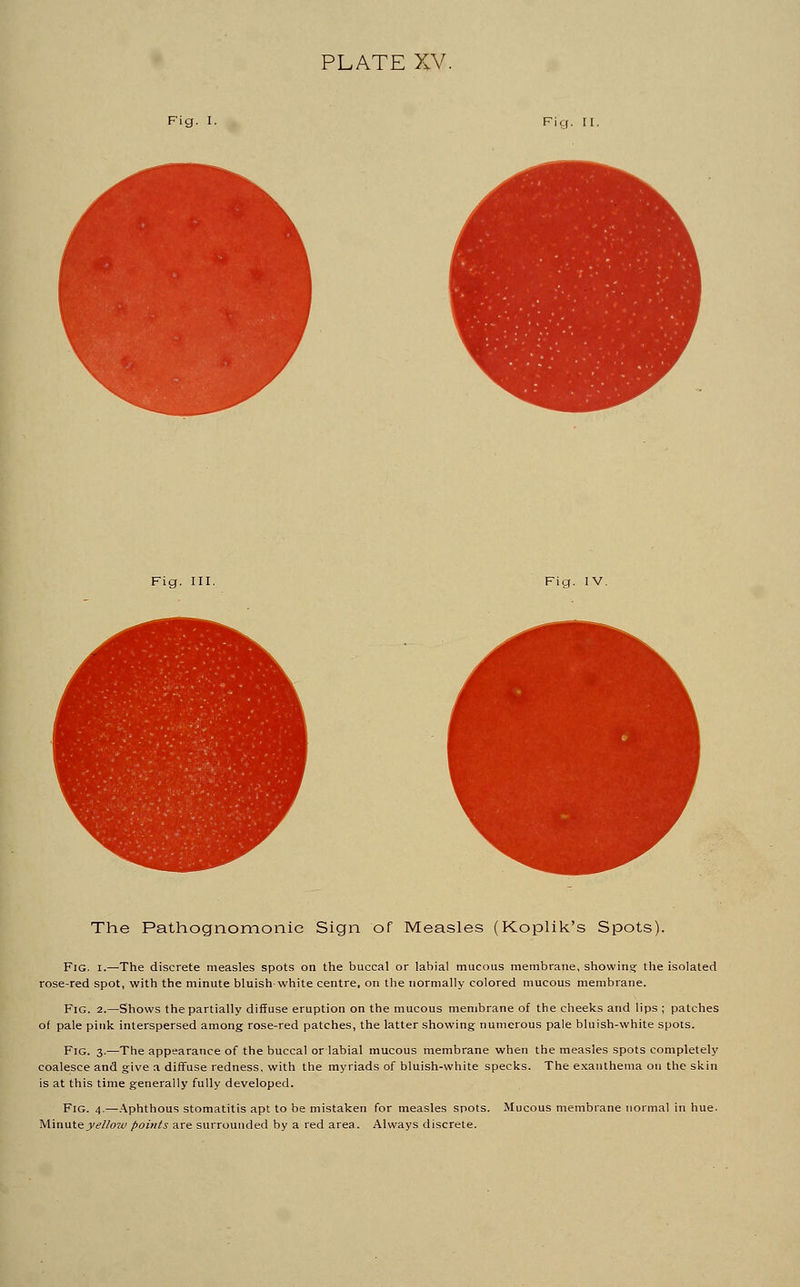 PLATE XV. The Pathognomonic Sign of Measles (Koplik's Spots). Fig. i.—The discrete measles spots on the buccal or labial mucous membrane, showing- the isolated se-red spot, with the minute bluish white centre, on the normally colored mucous membrane. Fig. 2.—Shows the partially diffuse eruption on the mucous membrane of the cheeks and lips ; patches 5 the partially diffuse eruption on th of pale pink interspersed among rose-red patches, the latter showing Fig. 3.—The appearance of the buccal or labial mucous membrane when the measles spots coalesce and give a diffuse redness, with the myriads of bluish-white specks. The exanthema is at this time generally fully developed. Fig. 4.—Aphthous stomatitis apt to be mistaken for measles spots. Mucous membrane noi Minute yellow points are surrounded by a red area. Always discrete. completely